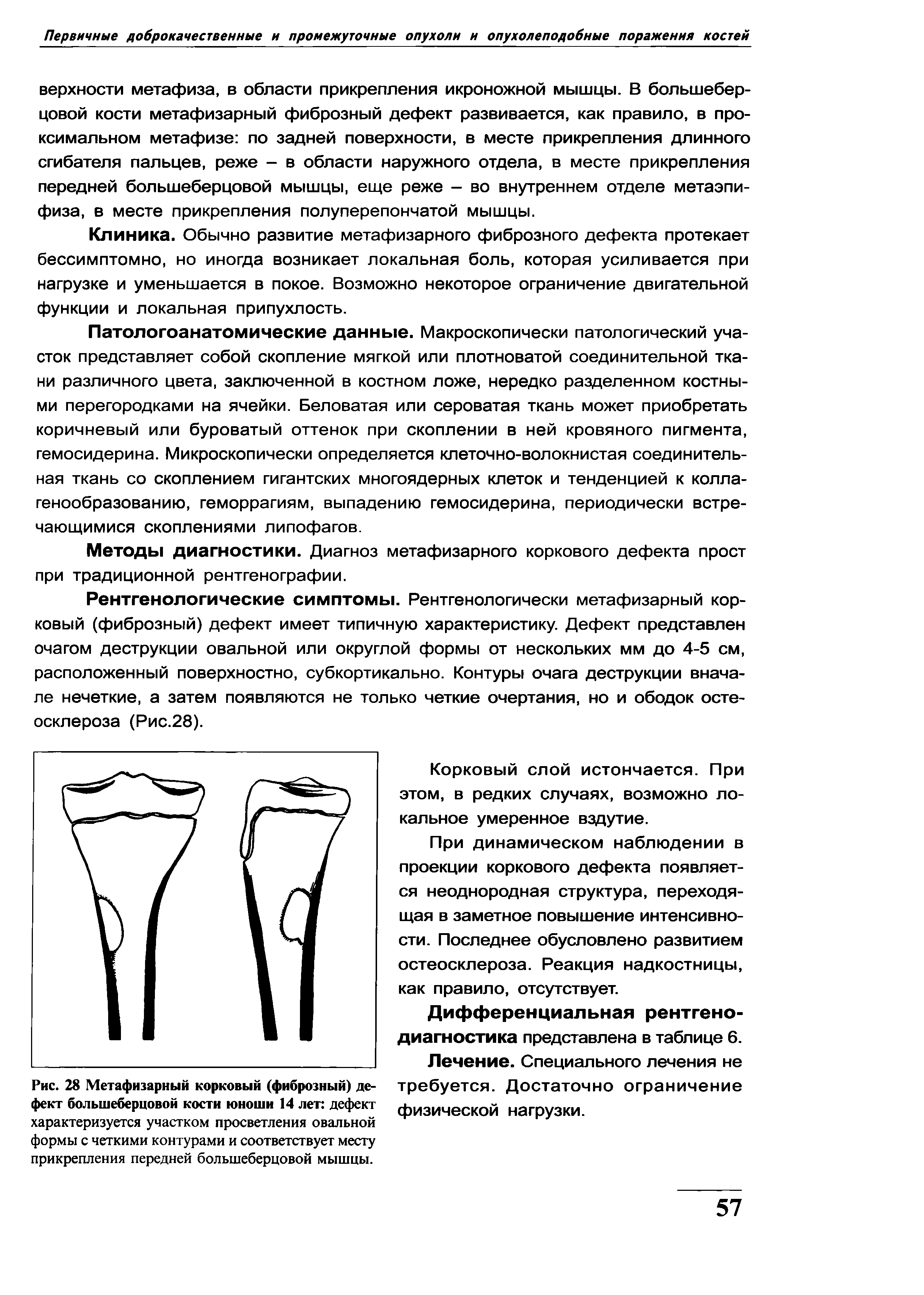 Рис. 28 Метафизарный корковый (фиброзный) дефект большеберцовой кости юноши 14 лет дефект характеризуется участком просветления овальной формы с четкими контурами и соответствует месту прикрепления передней большеберцовой мышцы.