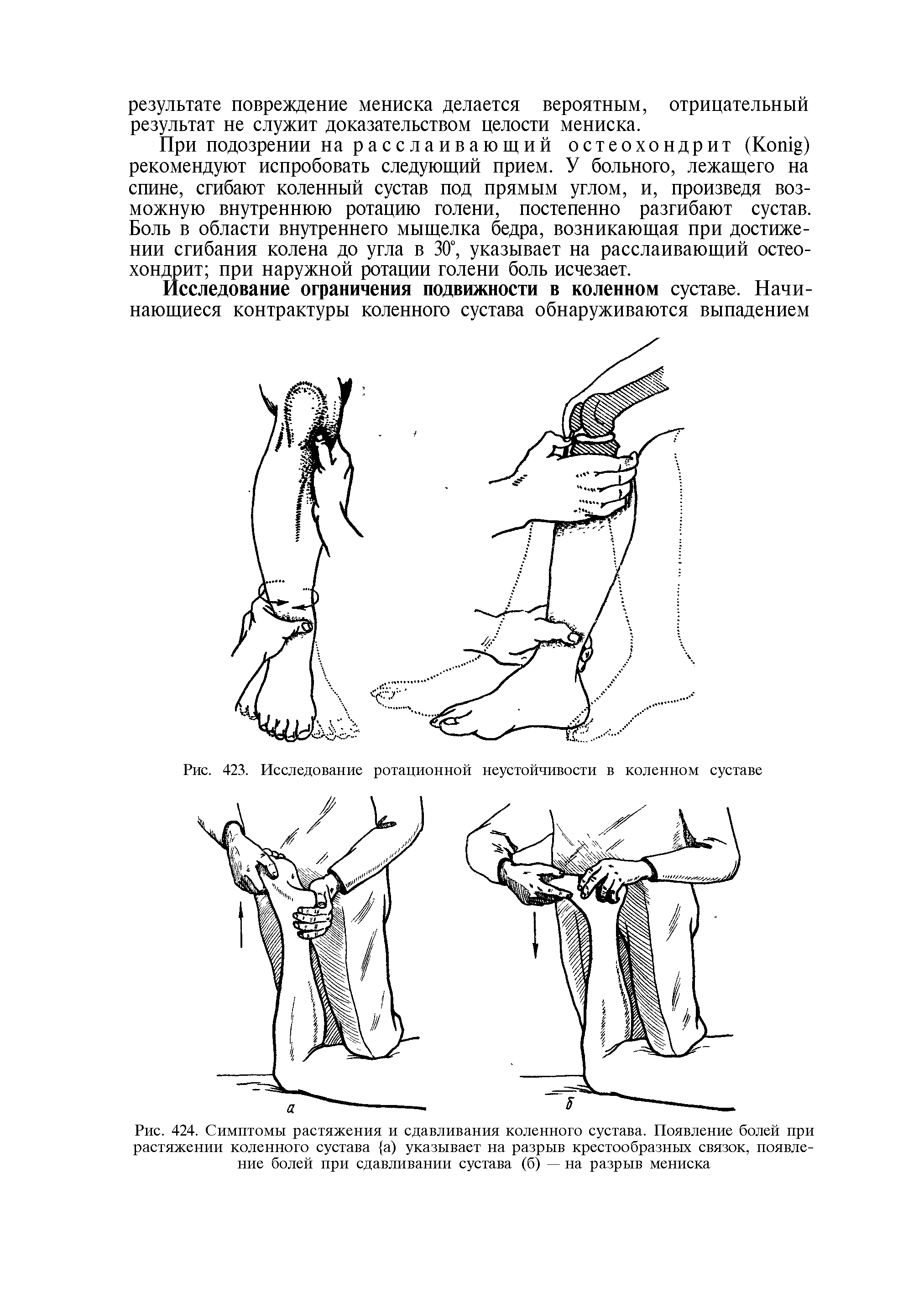 Рис. 424. Симптомы растяжения и сдавливания коленного сустава. Появление болей при растяжении коленного сустава а) указывает на разрыв крестообразных связок, появление болей при сдавливании сустава (б) — на разрыв мениска...