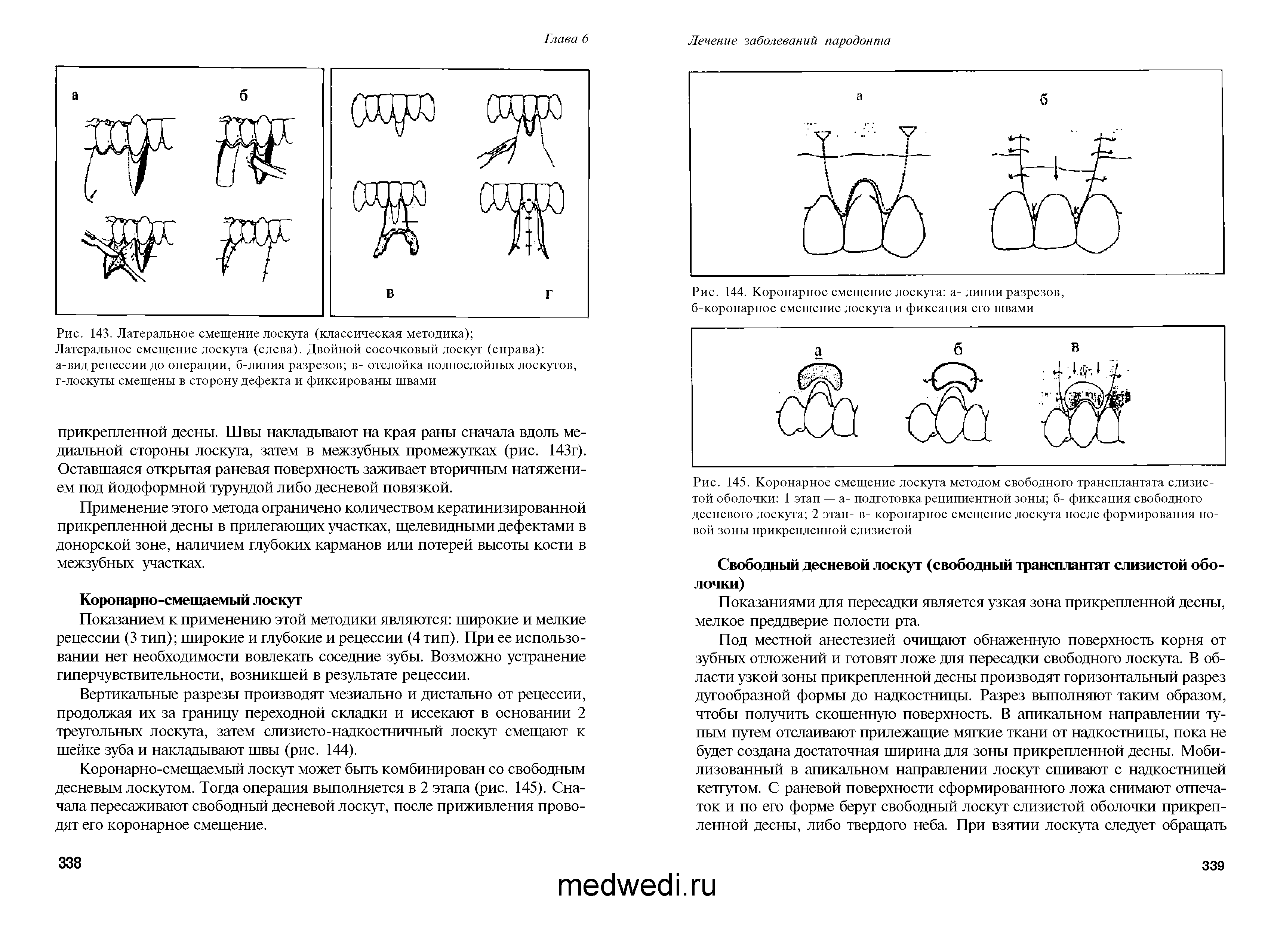 Рис. 145. Коронарное смещение лоскута методом свободного трансплантата слизистой оболочки 1 этап — а- подготовка реципиентной зоны б- фиксация свободного десневого лоскута 2 этап- в- коронарное смещение лоскута после формирования новой зоны прикрепленной слизистой...