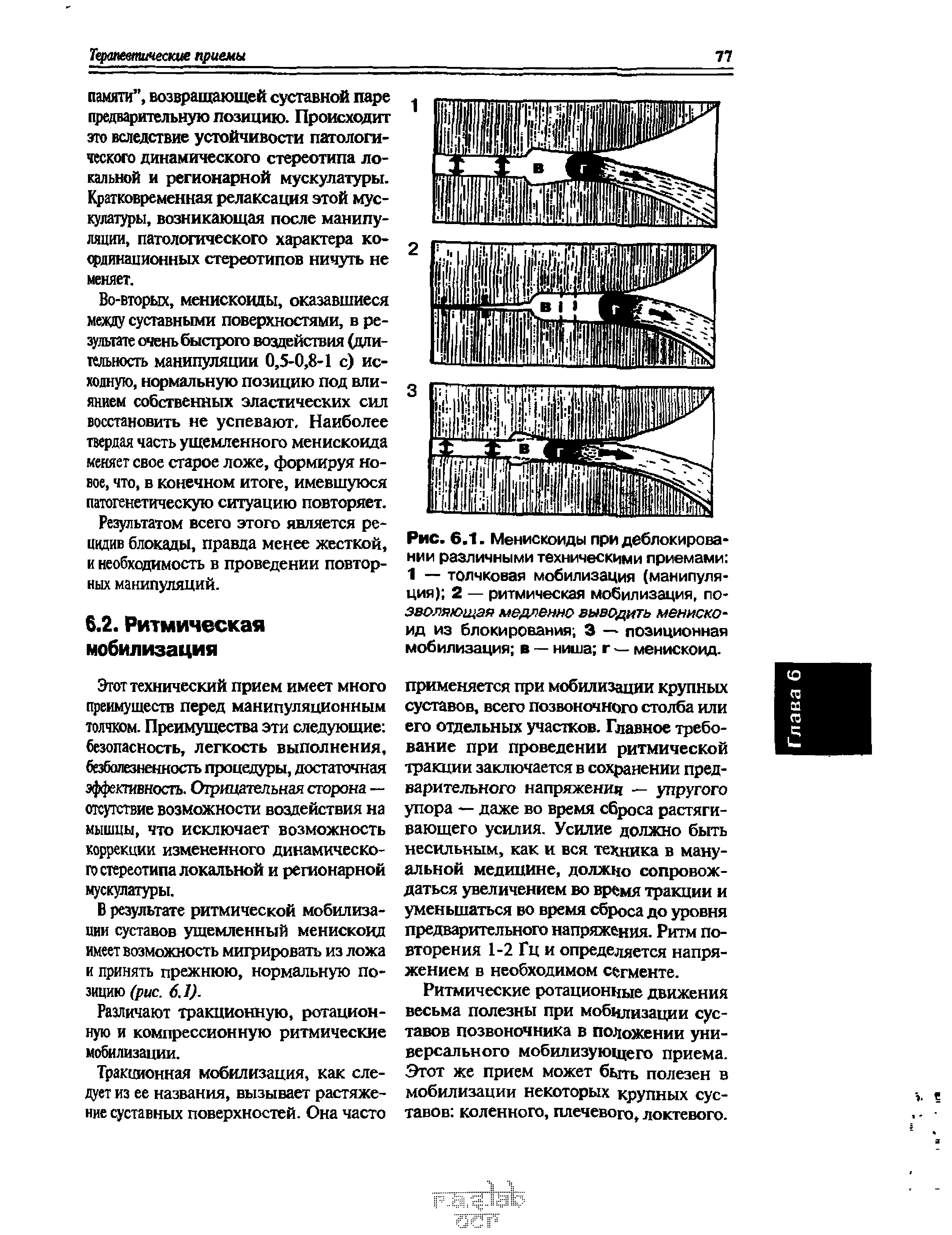 Рис. 6.1. Менискоиды при деблокировании различными техническими приемами 1 — толчковая мобилизация (манипуляция) 2 — ритмическая мобилизация, по-эволяющая медленно выводить мениско-ид из блокирования 3 — позиционная мобилизация в — ниша г — менискоид.