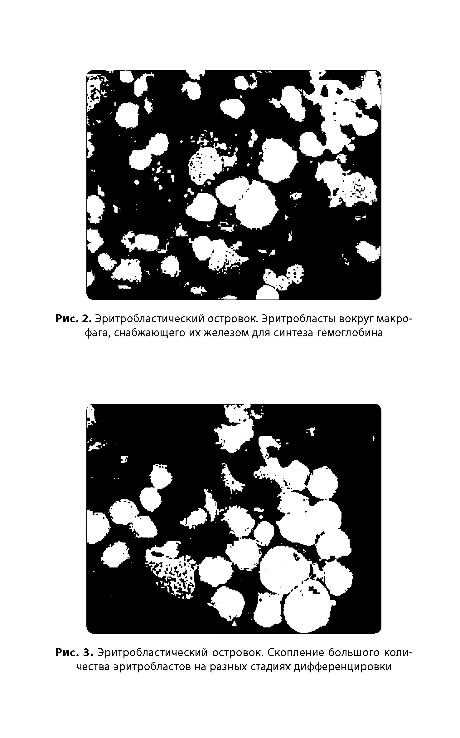 Рис. 3. Эритробластический островок. Скопление большого количества эритробластов на разных стадиях дифференцировки...