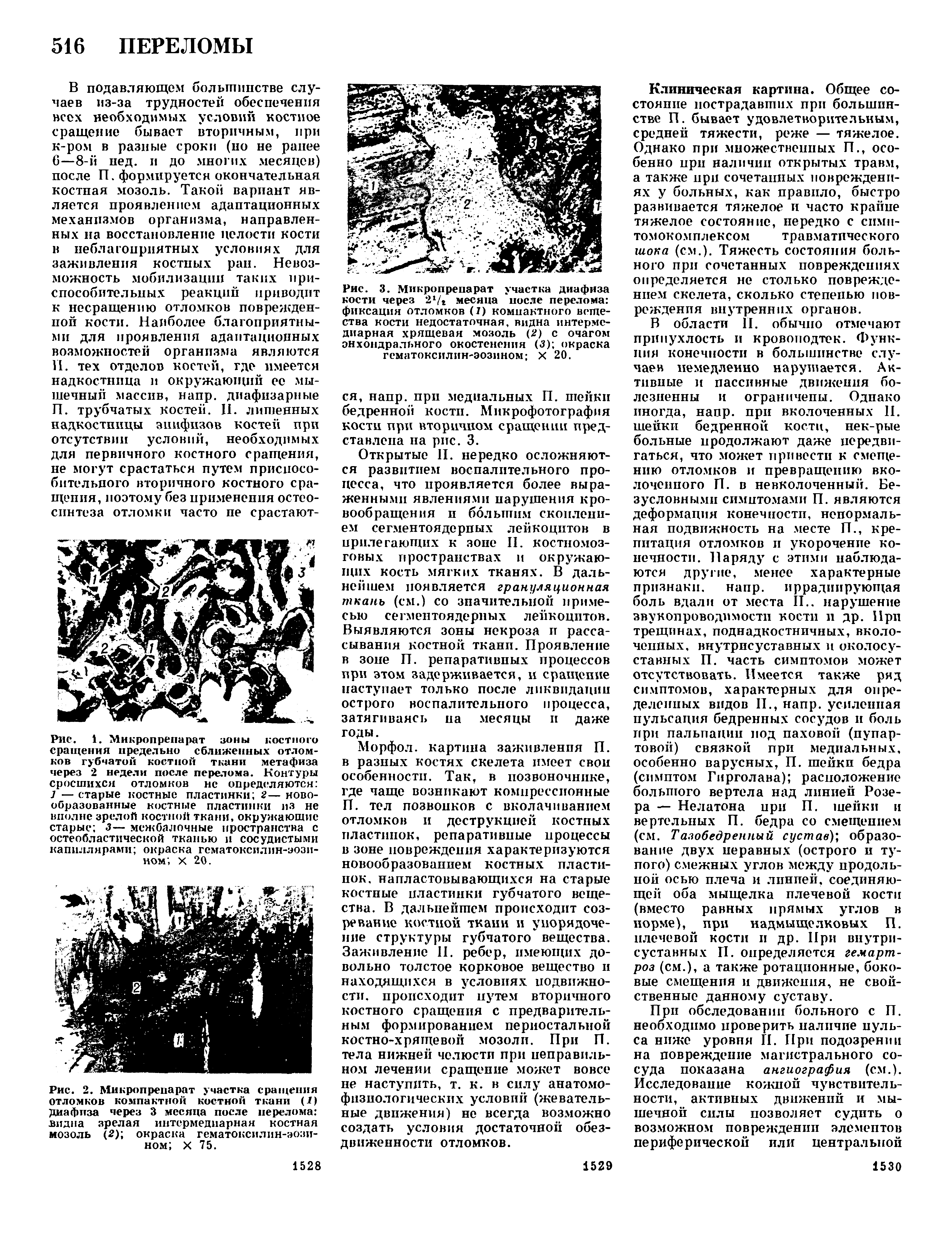 Рис. 2. Микропрепарат участка сращения отломков компактной костной ткани (1) диафиза через 3 месяца после перелома видна зрелая интермедиарная костная мозоль (2) окраска гематоксилин-эози-ном X 75.