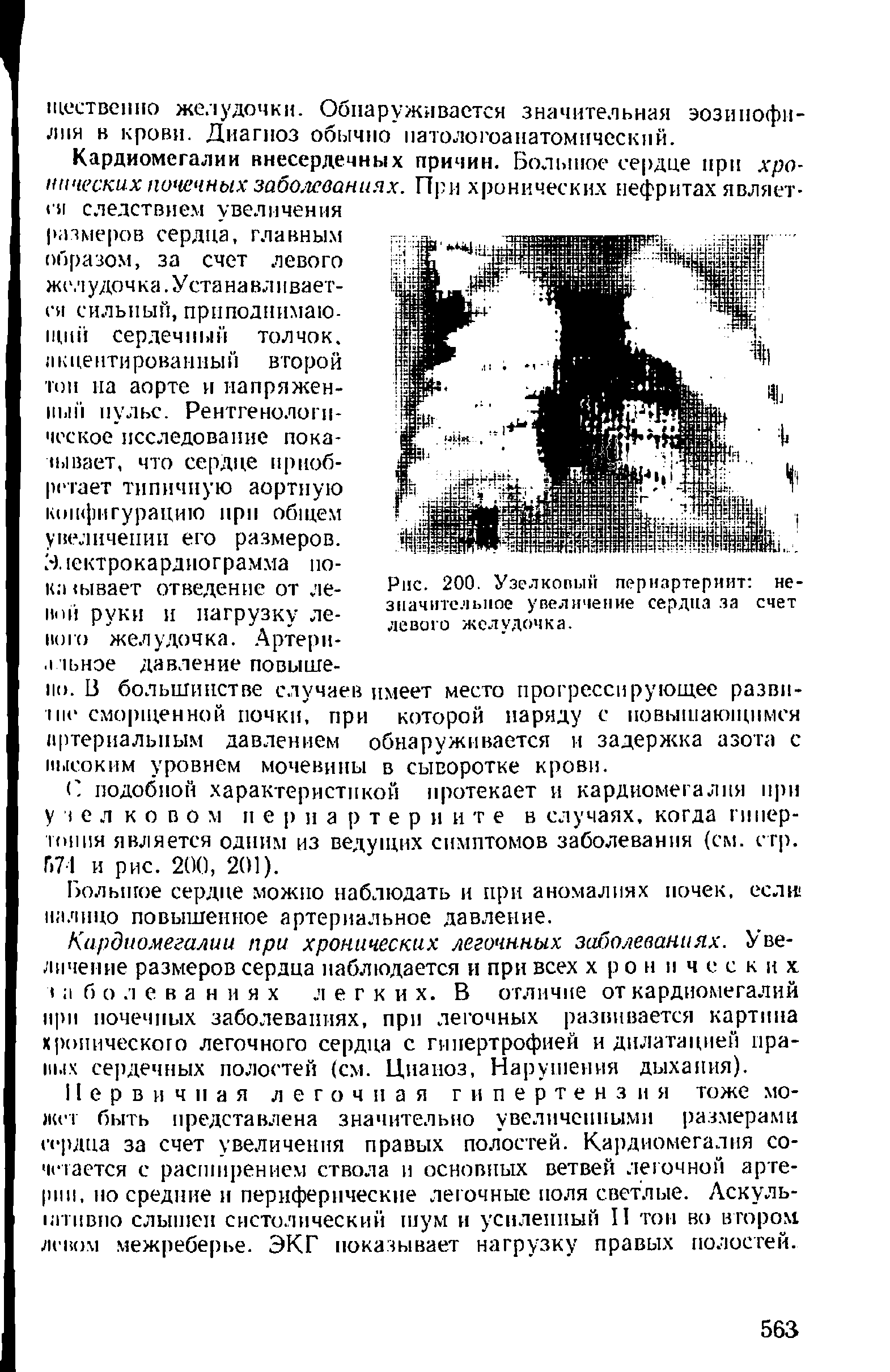 Рис. 200. Узелковый пернартериит незначительное увеличение сердца за счет левого желудочка.