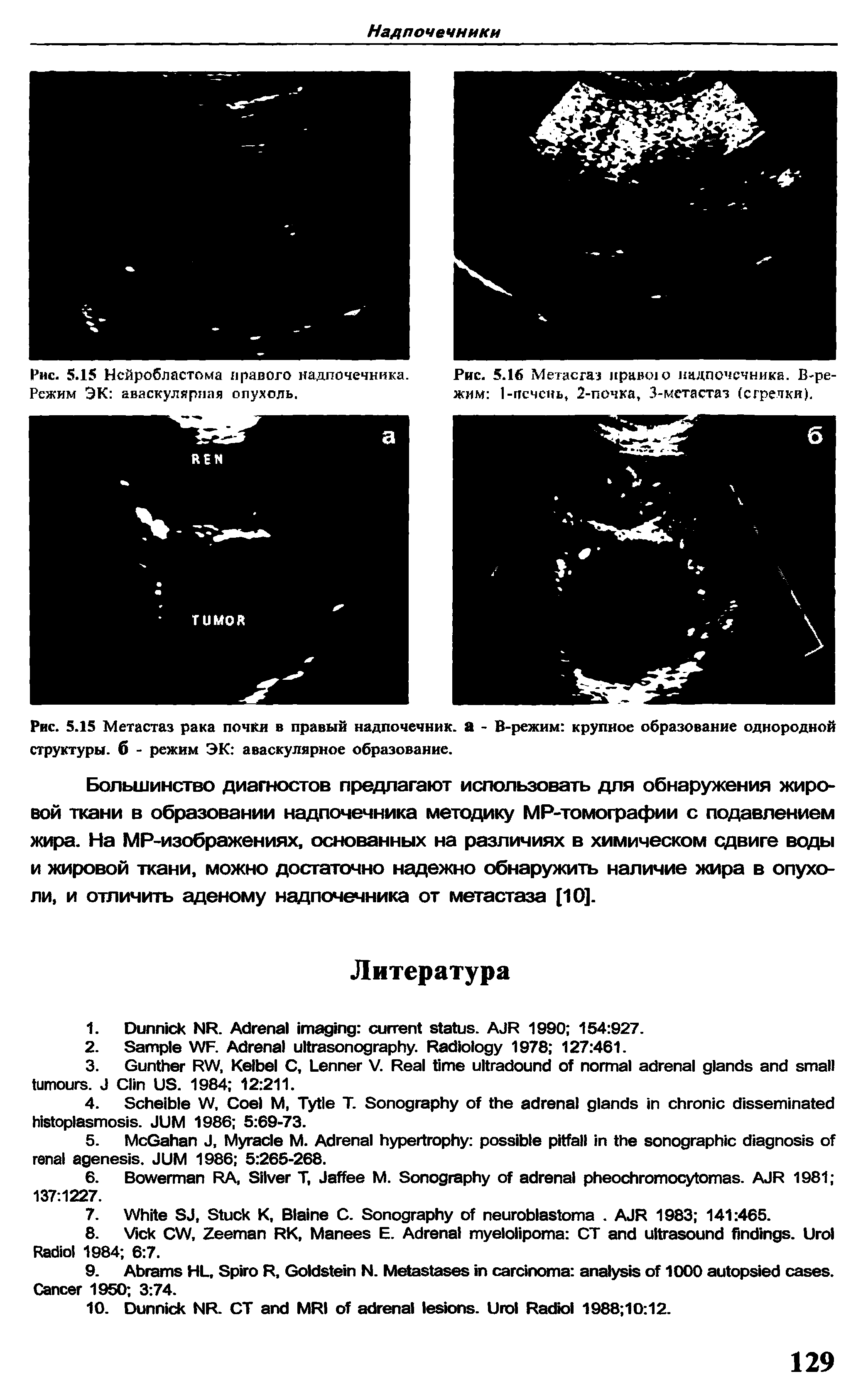 Рис. 5.15 Метастаз рака почки в правый надпочечник, а - В-режим крупное образование однородной структуры, б - режим ЭК аваскулярное образование.