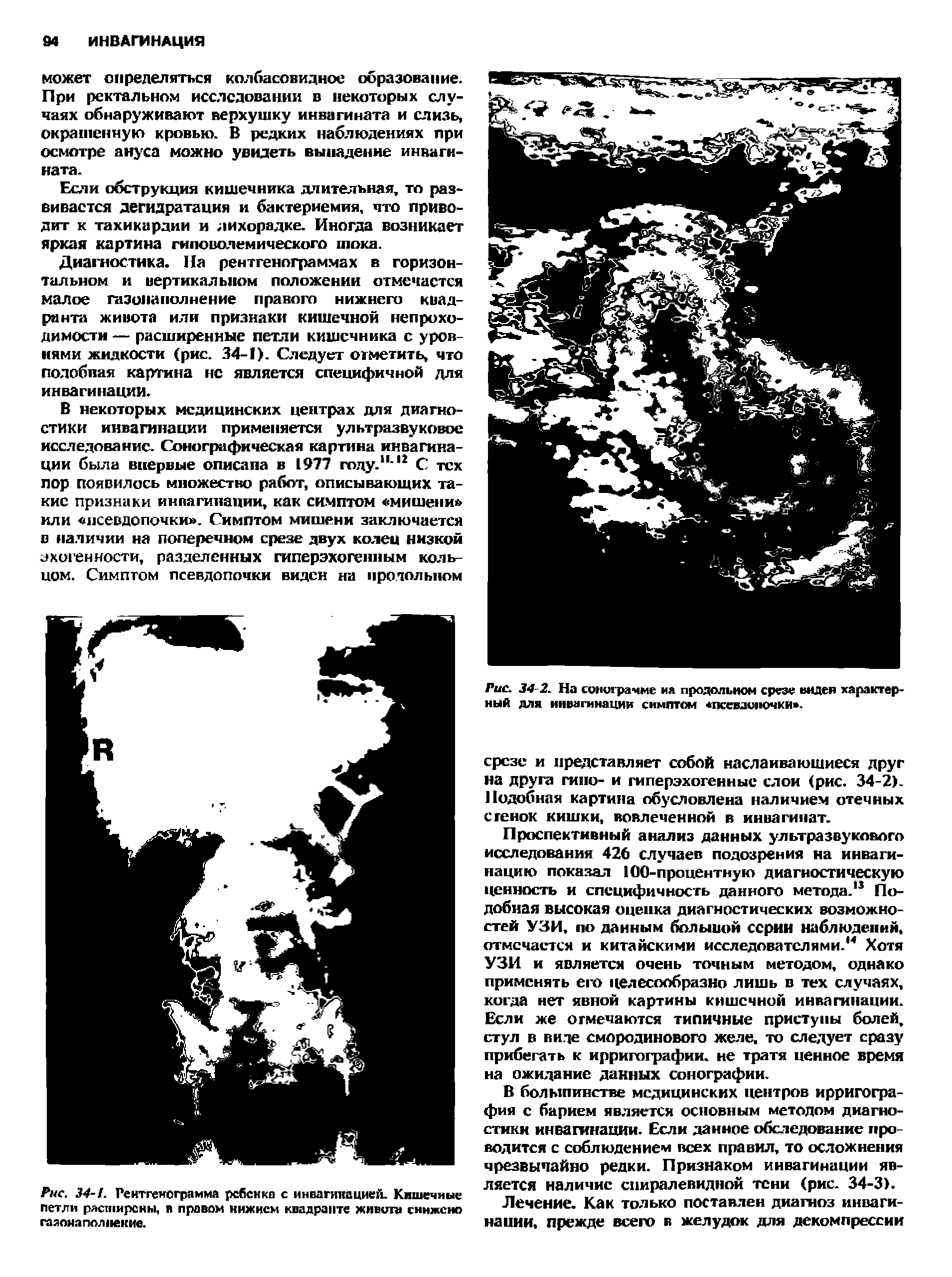 Рис. 34-1. Рентгенограмма ребенка с инвагинацией. Кишечные петли расширены, и правом нижнем квадранте живши снижено газона полнекие.