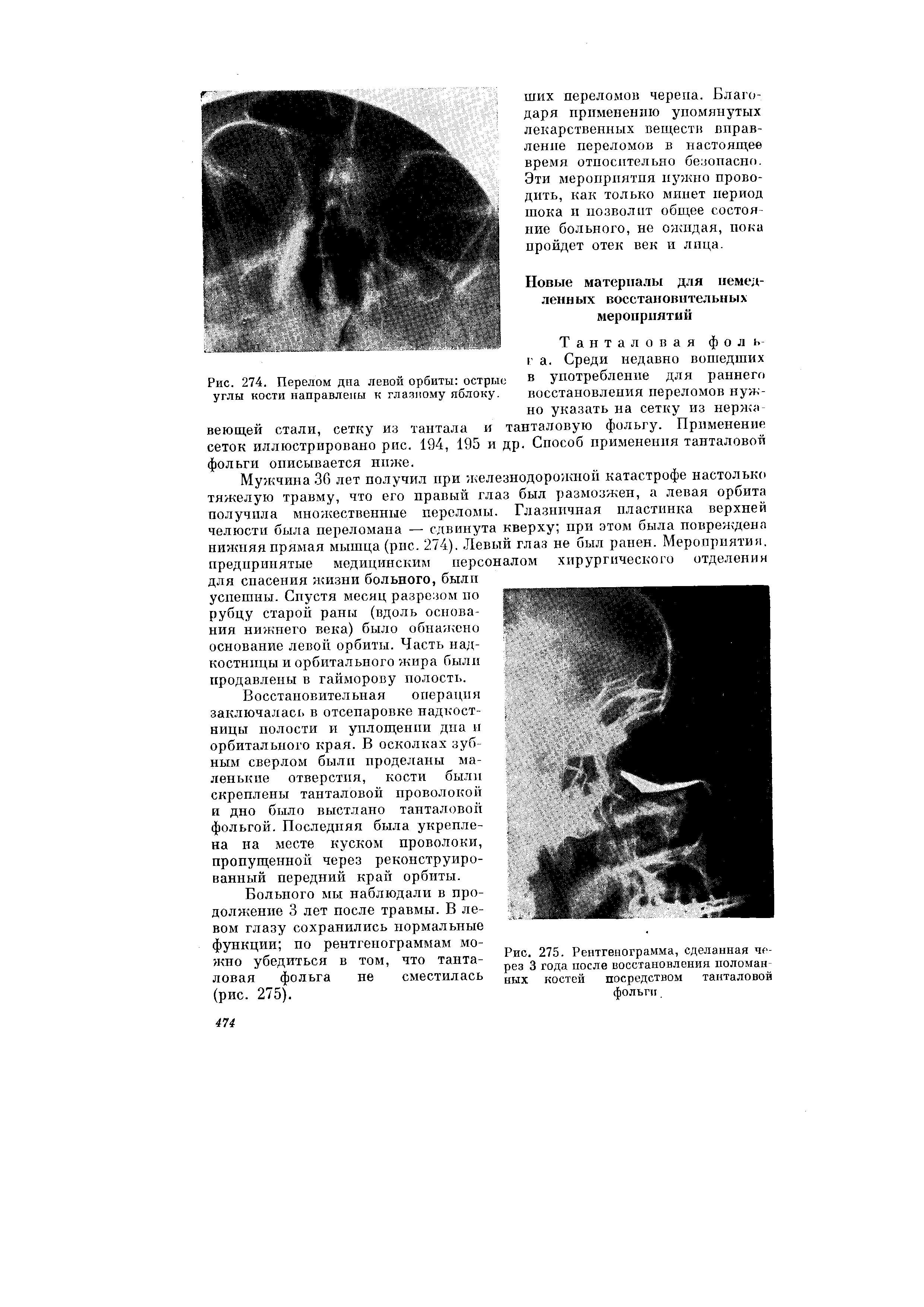 Рис. 275. Рентгенограмма, сделанная через 3 года после восстановления поломанных костей посредством танталовой фольги...