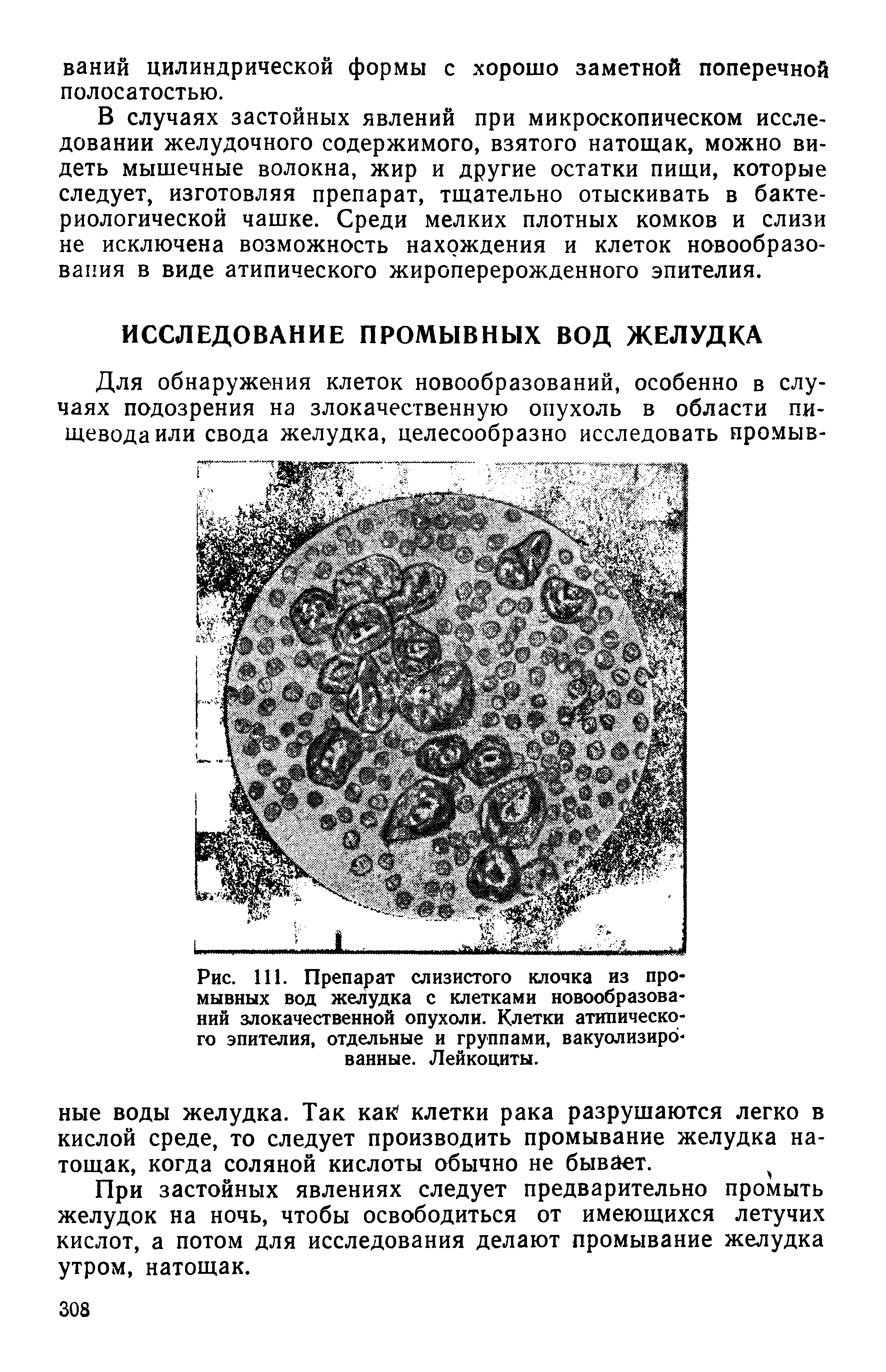 Рис. 111. Препарат слизистого клочка из промывных вод желудка с клетками новообразований злокачественной опухоли. Клетки атипического эпителия, отдельные и группами, вакуолизированные. Лейкоциты.