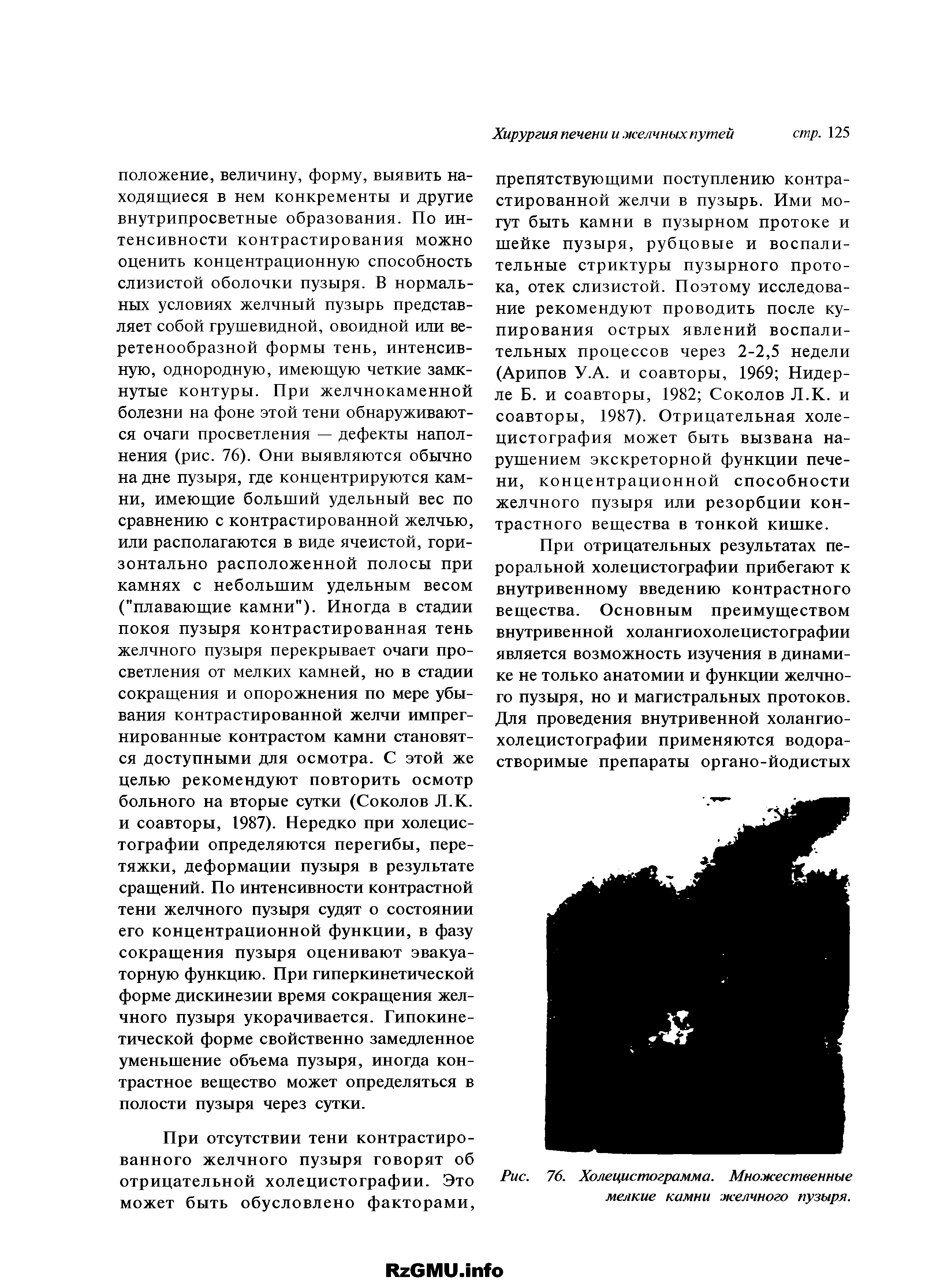 Рис. 76. Холецистограмма. Множественные мелкие камни желчного пузыря.