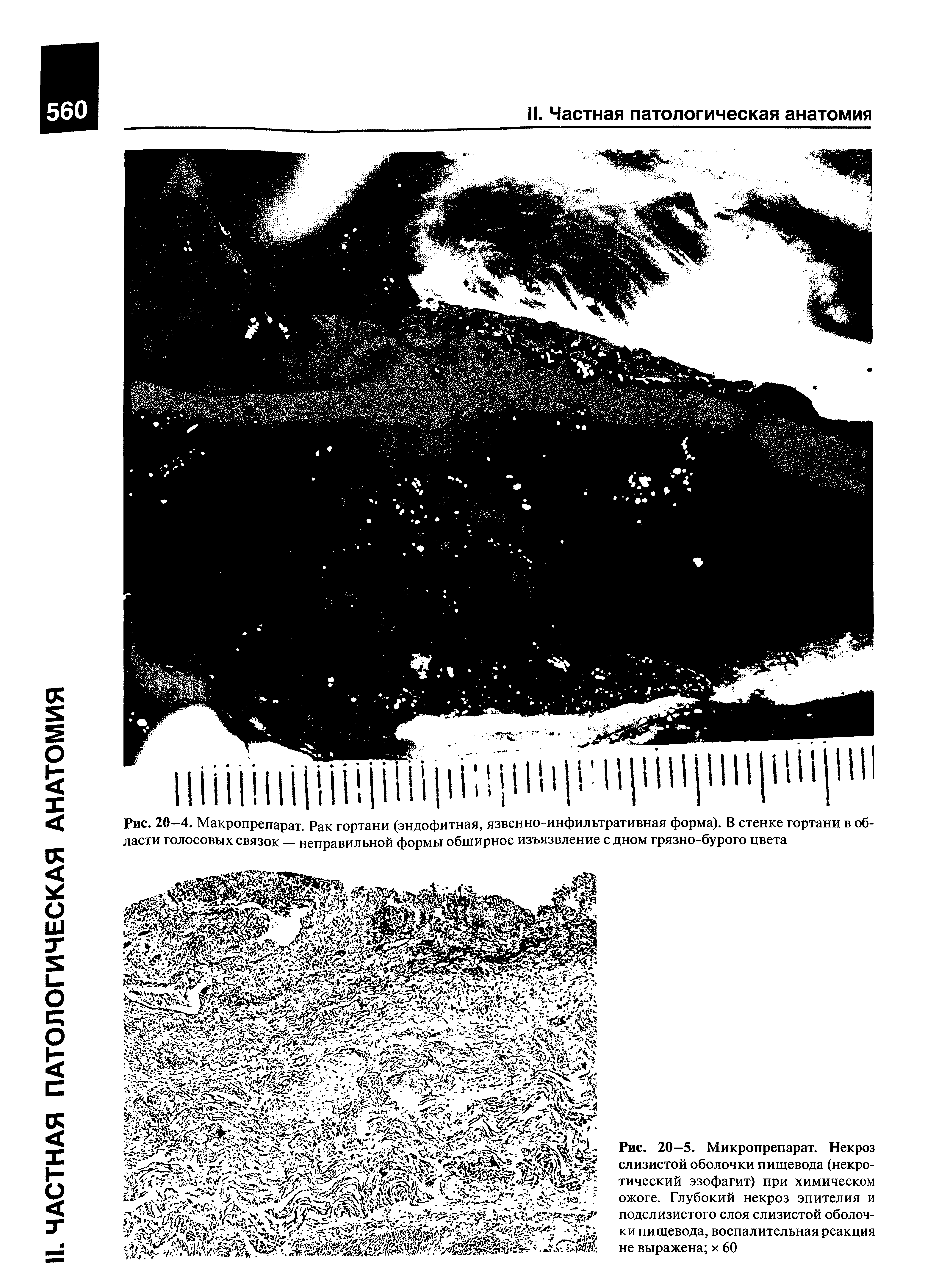 Рис. 20—5. Микропрепарат. Некроз слизистой оболочки пищевода (некротический эзофагит) при химическом ожоге. Глубокий некроз эпителия и подслизистого слоя слизистой оболочки пищевода, воспалительная реакция не выражена х 60...