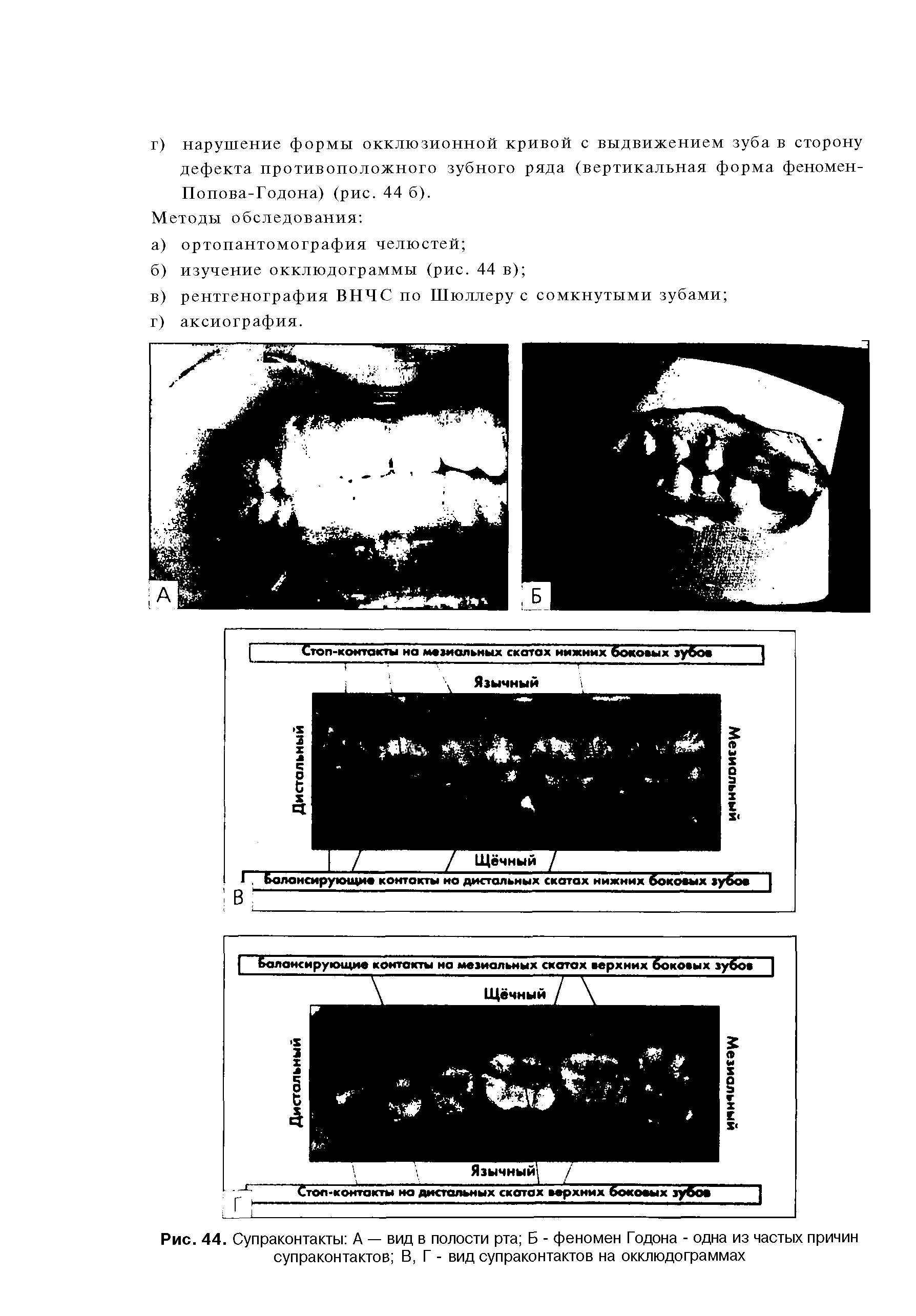 Рис. 44. Супраконтакты А — вид в полости рта Б - феномен Годона - одна из частых причин супраконтактов В, Г - вид супраконтактов на окклюдограммах...