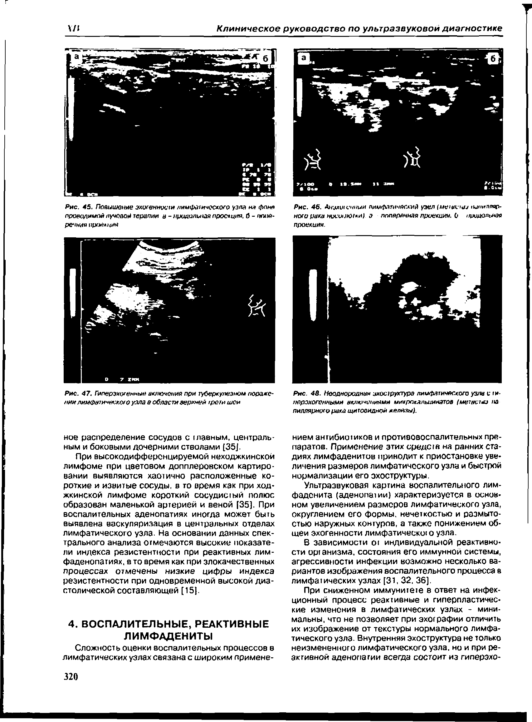 Рис. 47. Гиперэхогенные акпкучония при туберкулезном поражении лимфити нн шр узла а области верхней гром шеи...