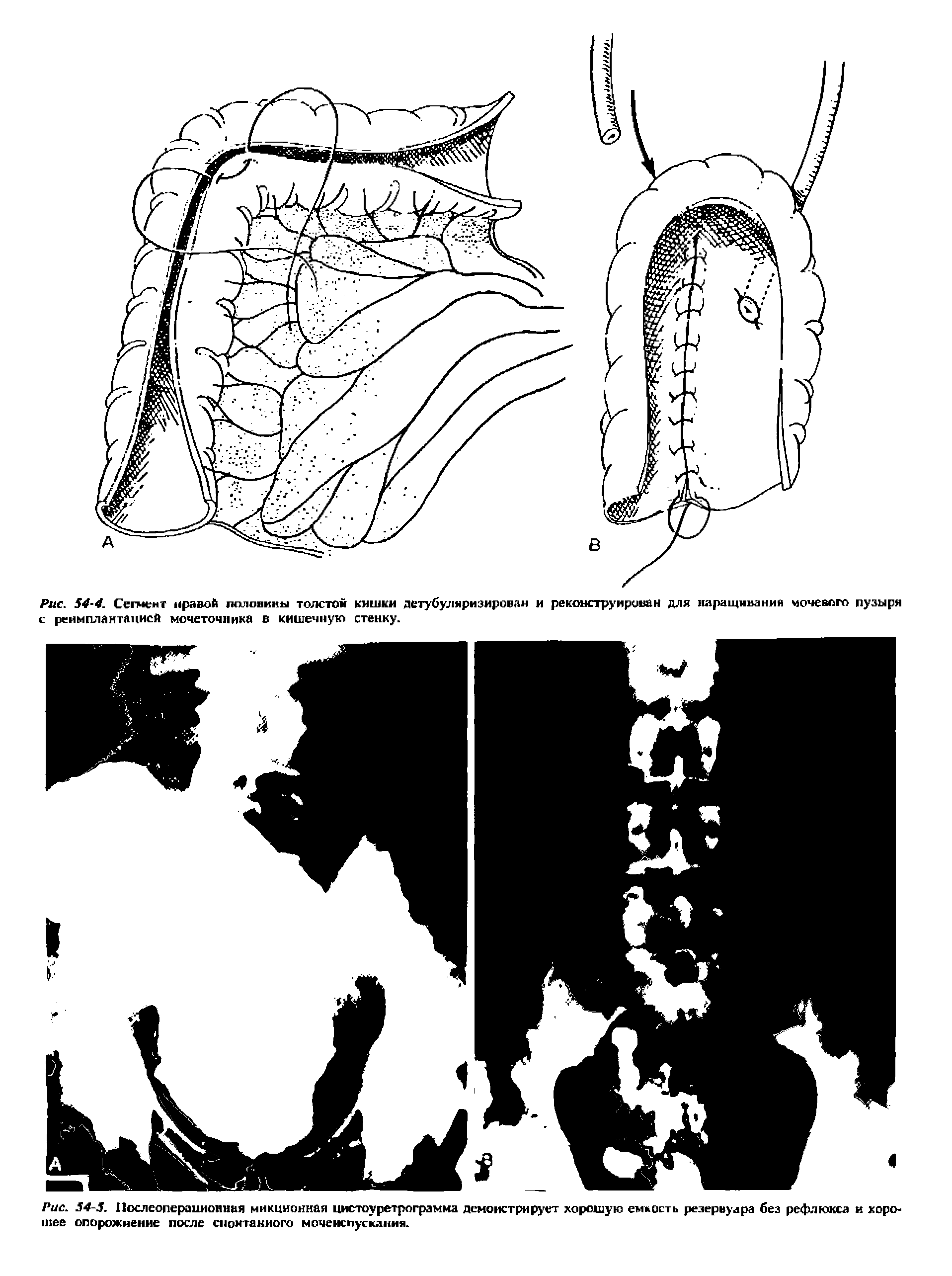 Рис. 54-4. Сегмент правой половины толстой кишки детубуляризирован и реконструирован для наращивания моченого пузыря с реимплантацией мочеточника в кишечную стенку.