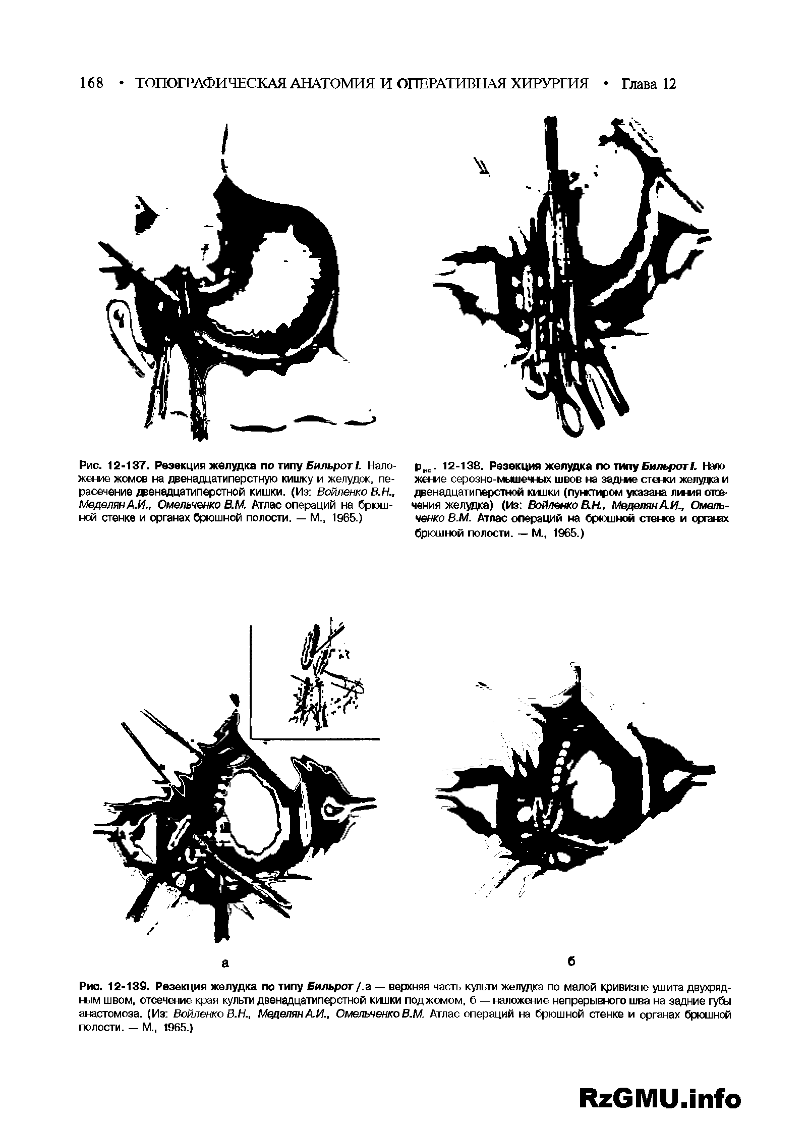 Рис. 12-137. Резекция желудка по типу Бильрот . Наложение жомов на двенадцатиперстную кишку и желудок, пе-расечение двенадцатиперстной кишки. (Из Войленко В.Н., МеделянА.И., Омельченко В.М. Атлас операций на брюшной стенке и органах брюшной полости. — М., 1965.)...