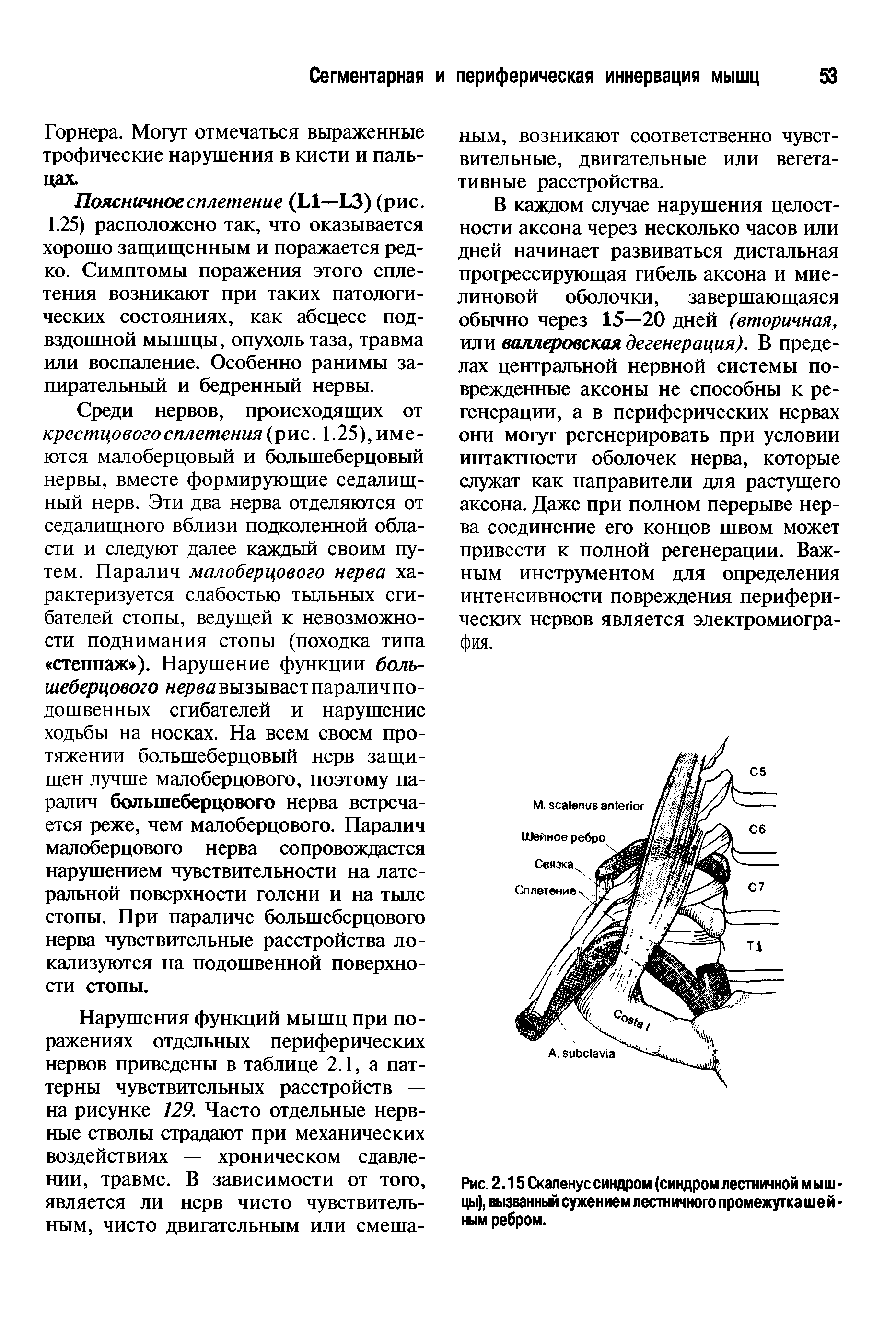 Рис. 2.15 Скаленус синдром (синдром лестничной м ы ш -цы), вызванный сужением лестничного промежутка ш е й -н>1м ребром.