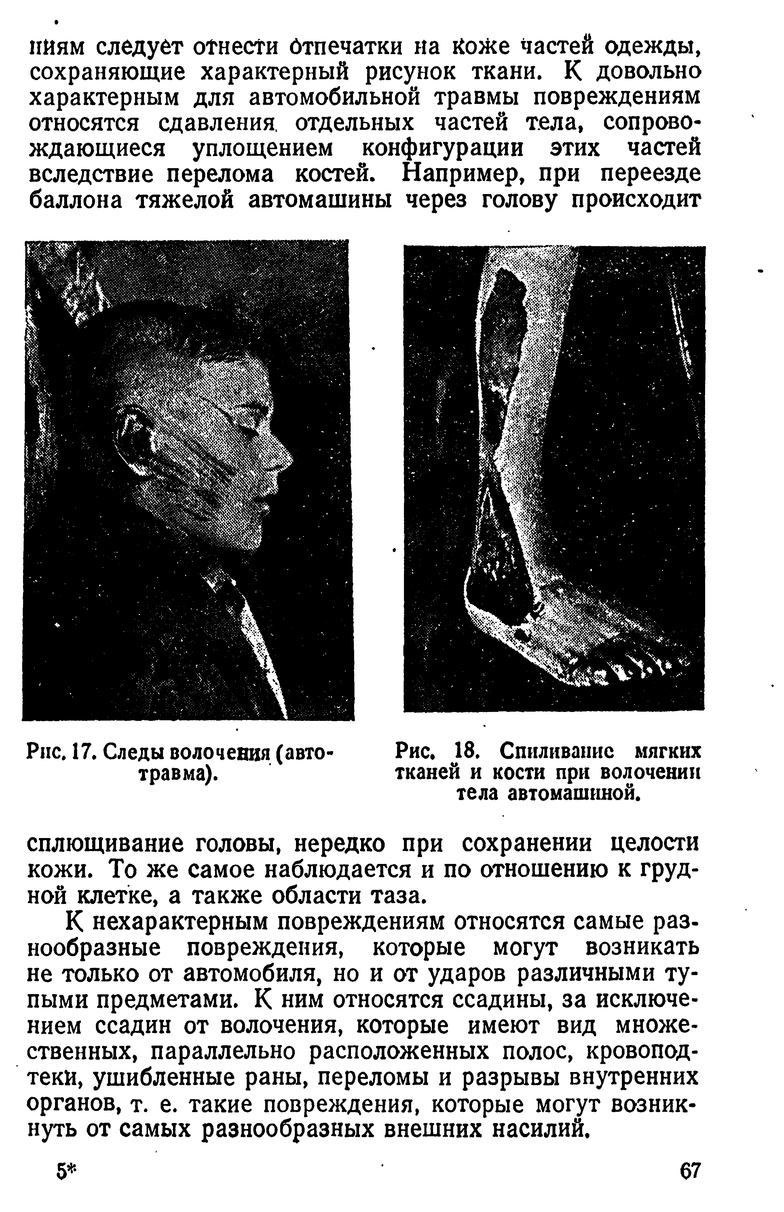 Рис. 18. Спиливание мягких тканей и кости при волочении тела автомашиной.