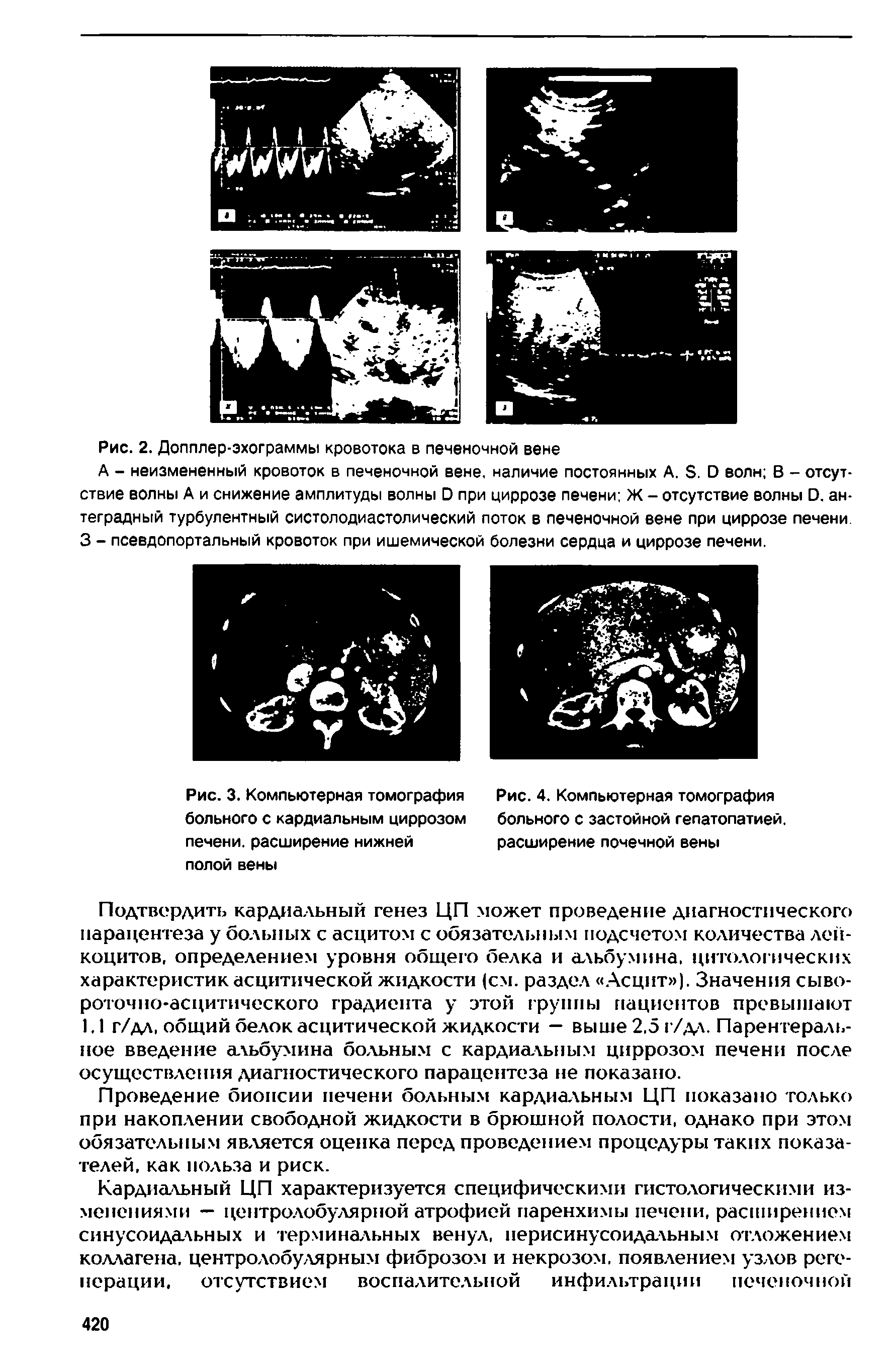 Рис. 3. Компьютерная томография больного с кардиальным циррозом печени, расширение нижней полой вены...