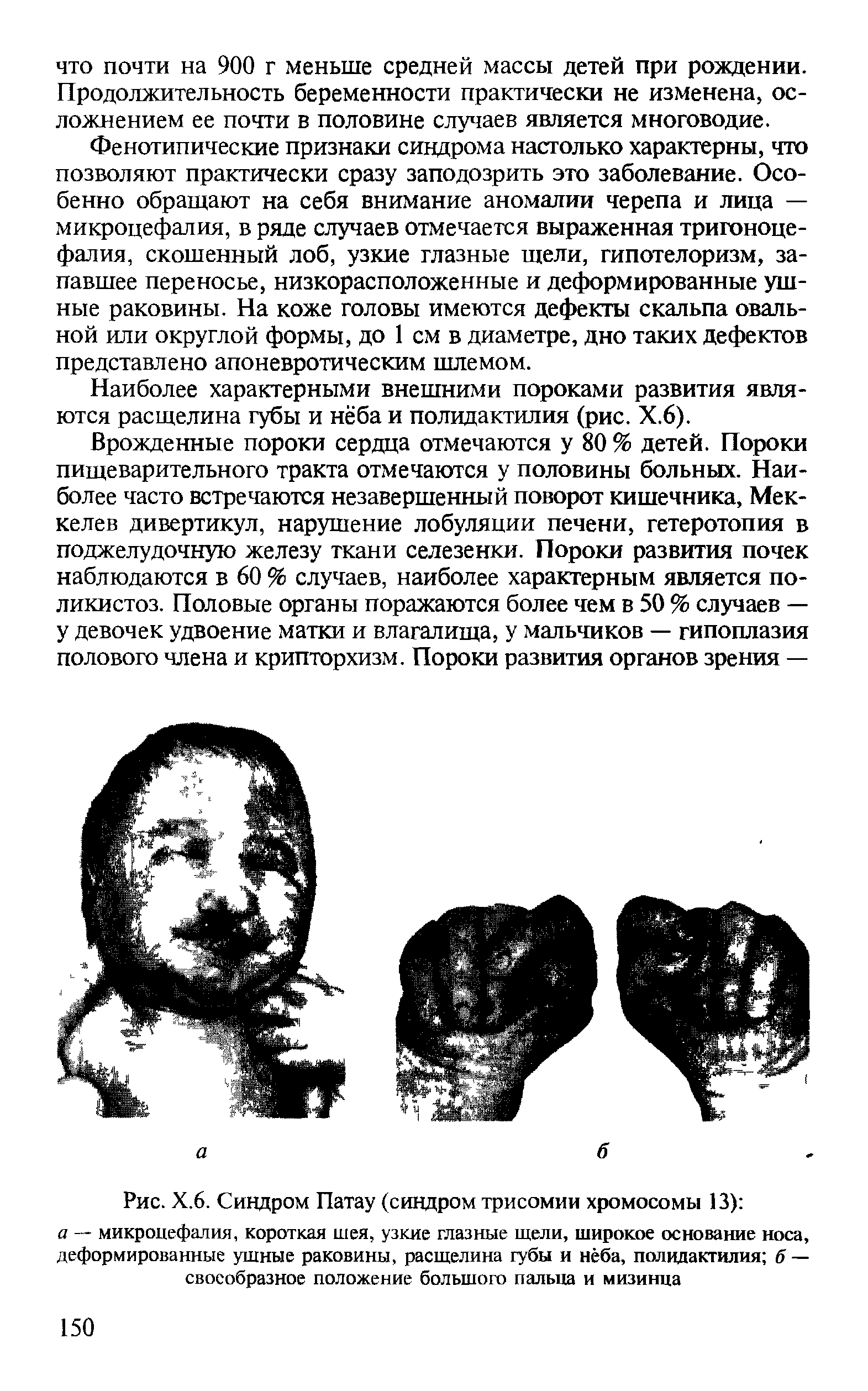 Рис. Х.6. Синдром Патау (синдром трисомии хромосомы 13) а — микроцефалия, короткая шея, узкие глазные щели, широкое основание носа, деформированные ушные раковины, расщелина губы и нёба, полидактилия б — своеобразное положение большого пальца и мизинца...