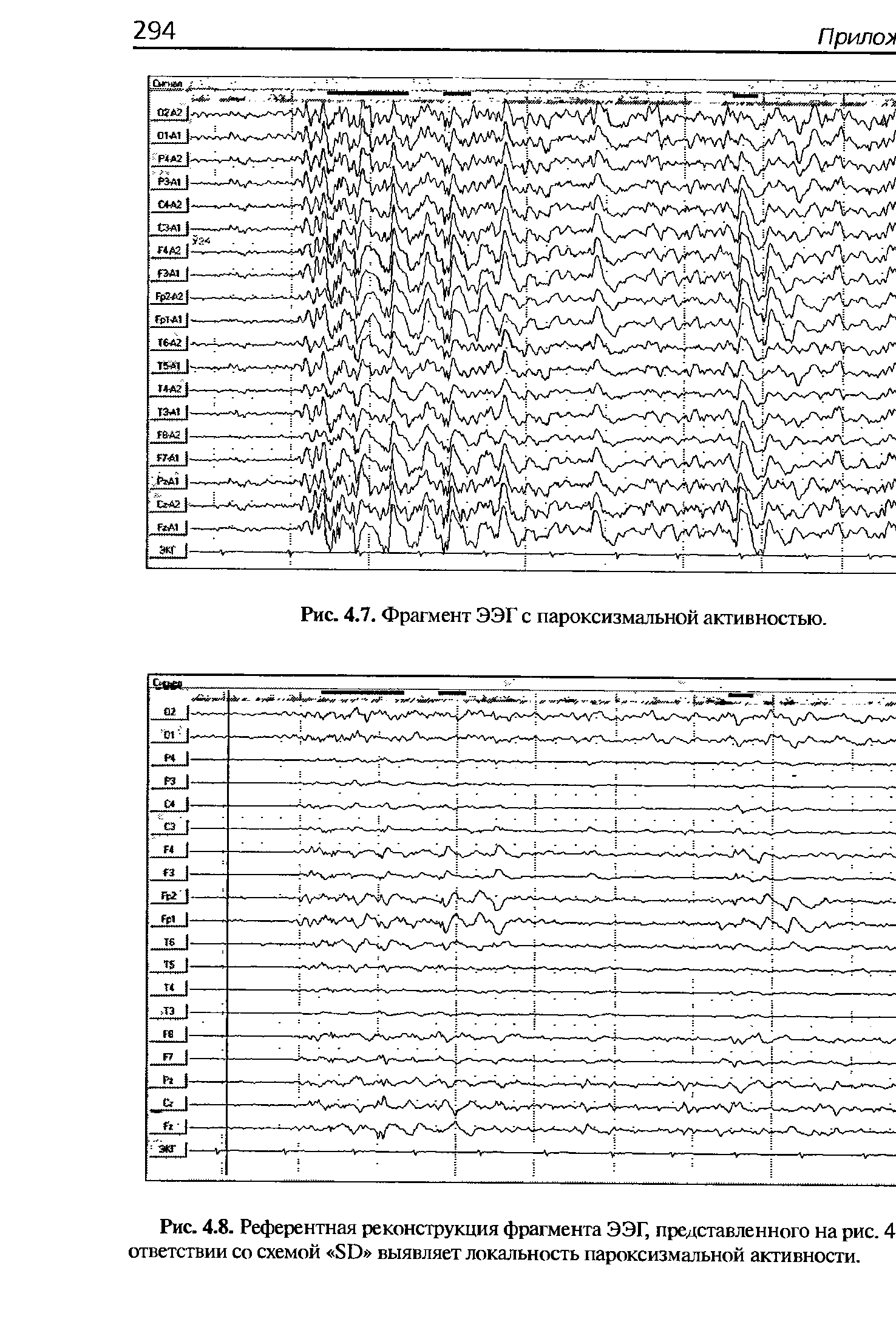 Рис. 4.8. Референтная реконструкция фрагмента ЭЭГ, представленного на рис. 4 ответствии со схемой 5Е> выявляет локальность пароксизмальной активности.