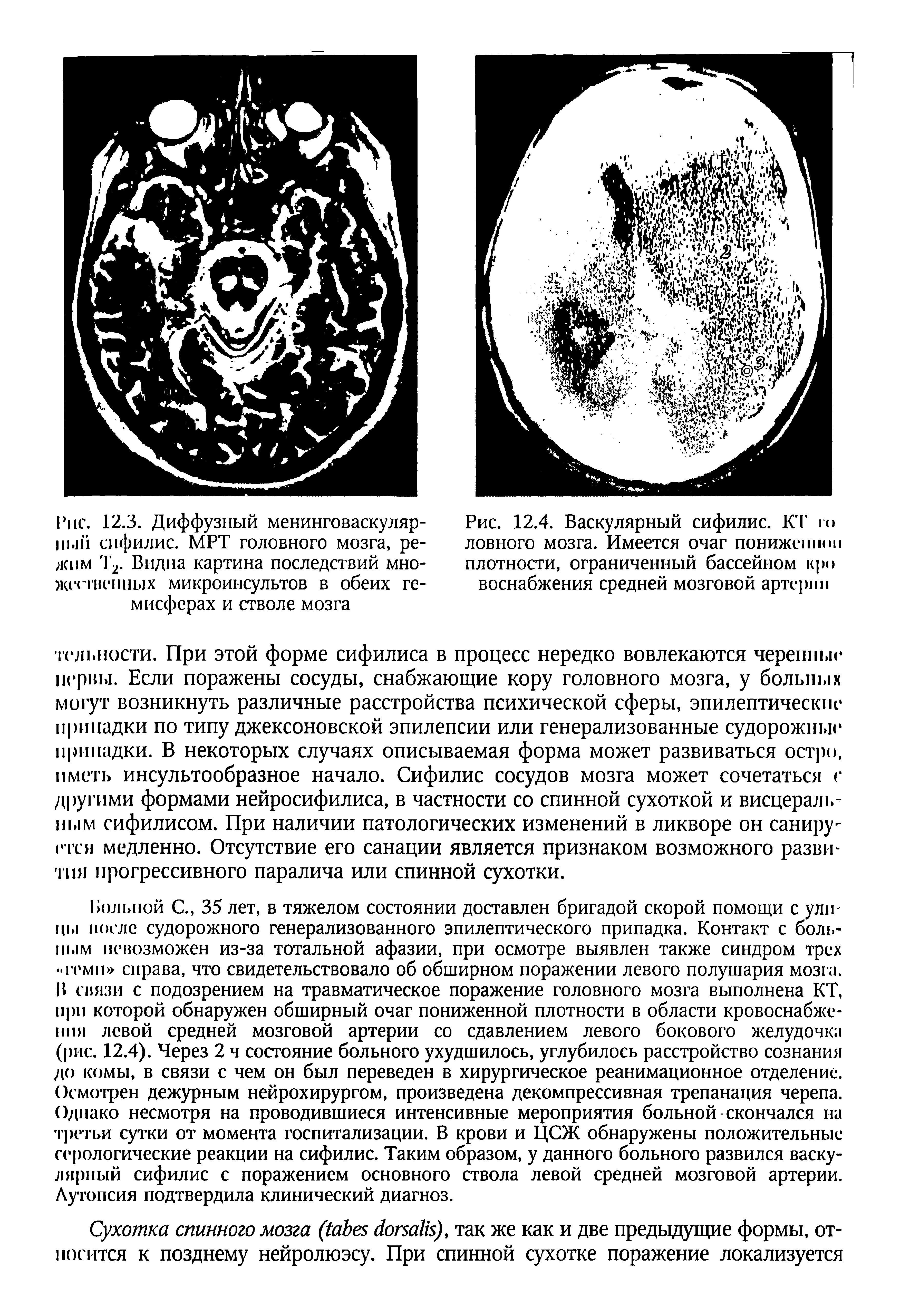 Рис. 12.4. Васкулярный сифилис. КТ к> ловного мозга. Имеется очаг пониже и шп плотности, ограниченный бассейном кро воснабжения средней мозговой артерии...