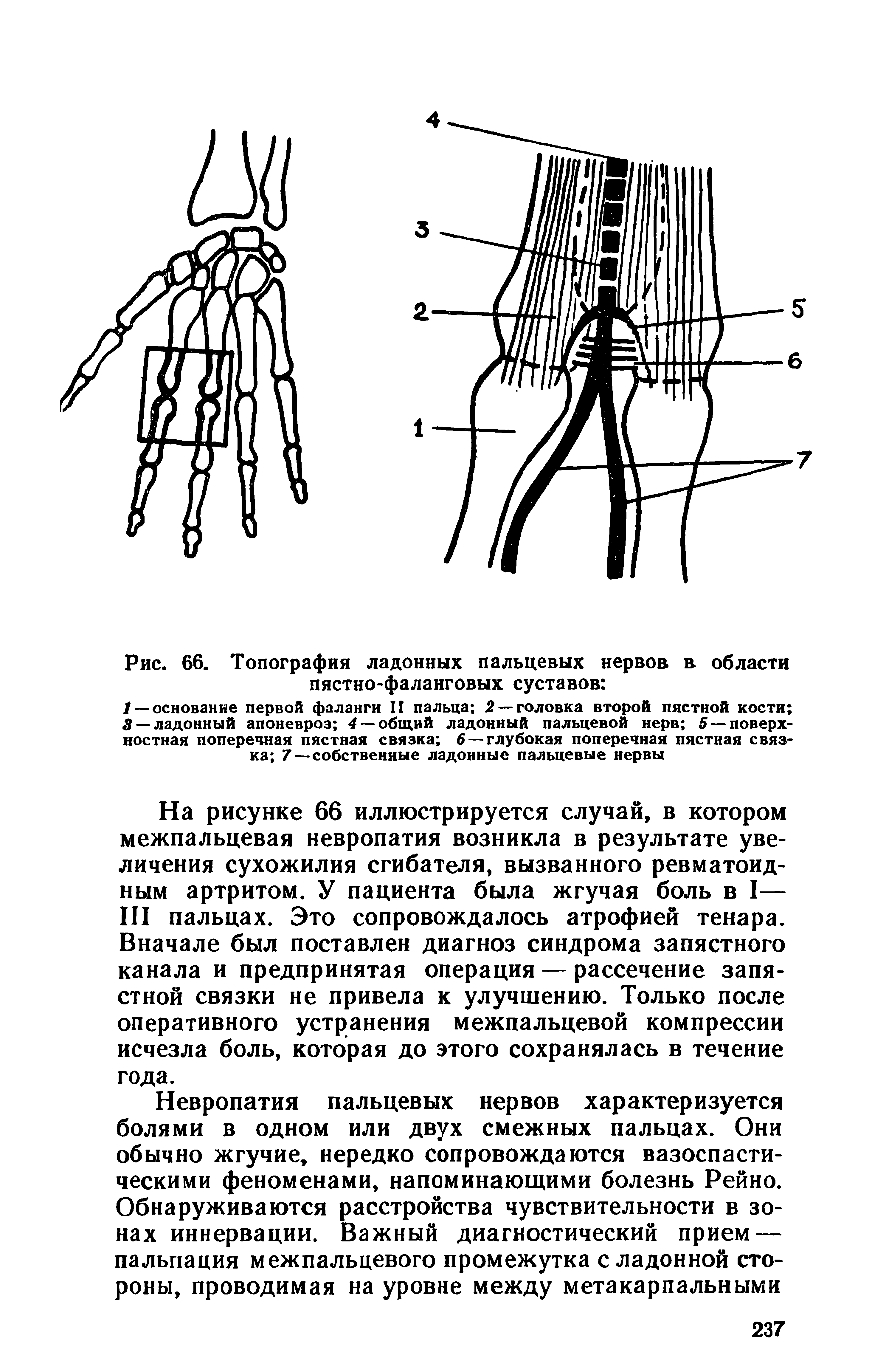 Рис. 66. Топография ладонных пальцевых нервов в области пястно-фаланговых суставов ...