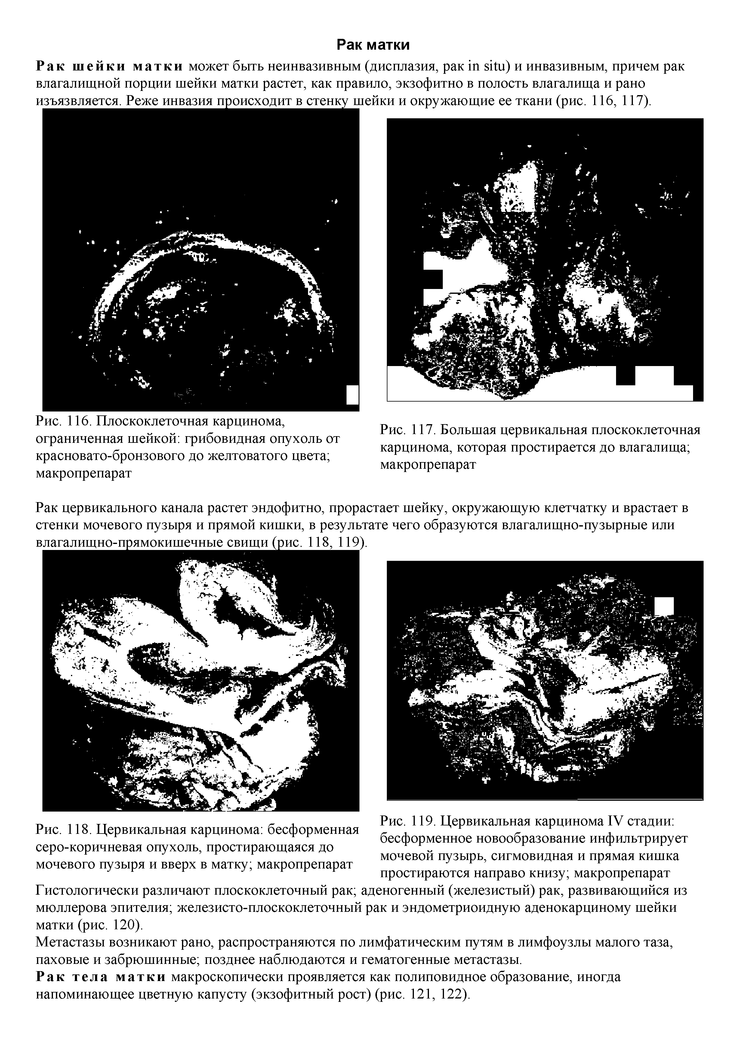 Рис. 118. Цервикальная карцинома бесформенная серо-коричневая опухоль, простирающаяся до мочевого пузыря и вверх в матку макропрепарат...