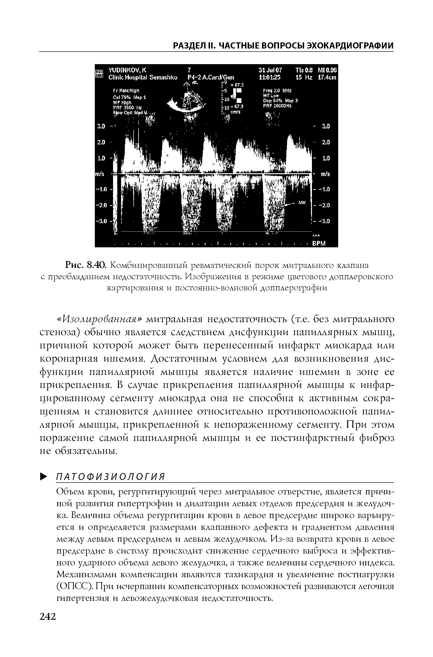 Рис. 8.40. Комбинированный ревматический порок митрального клапана с преобладанием недостаточности. Изображения в режиме цветового допплеровского картирования и постоянно-волновой допплерографии...