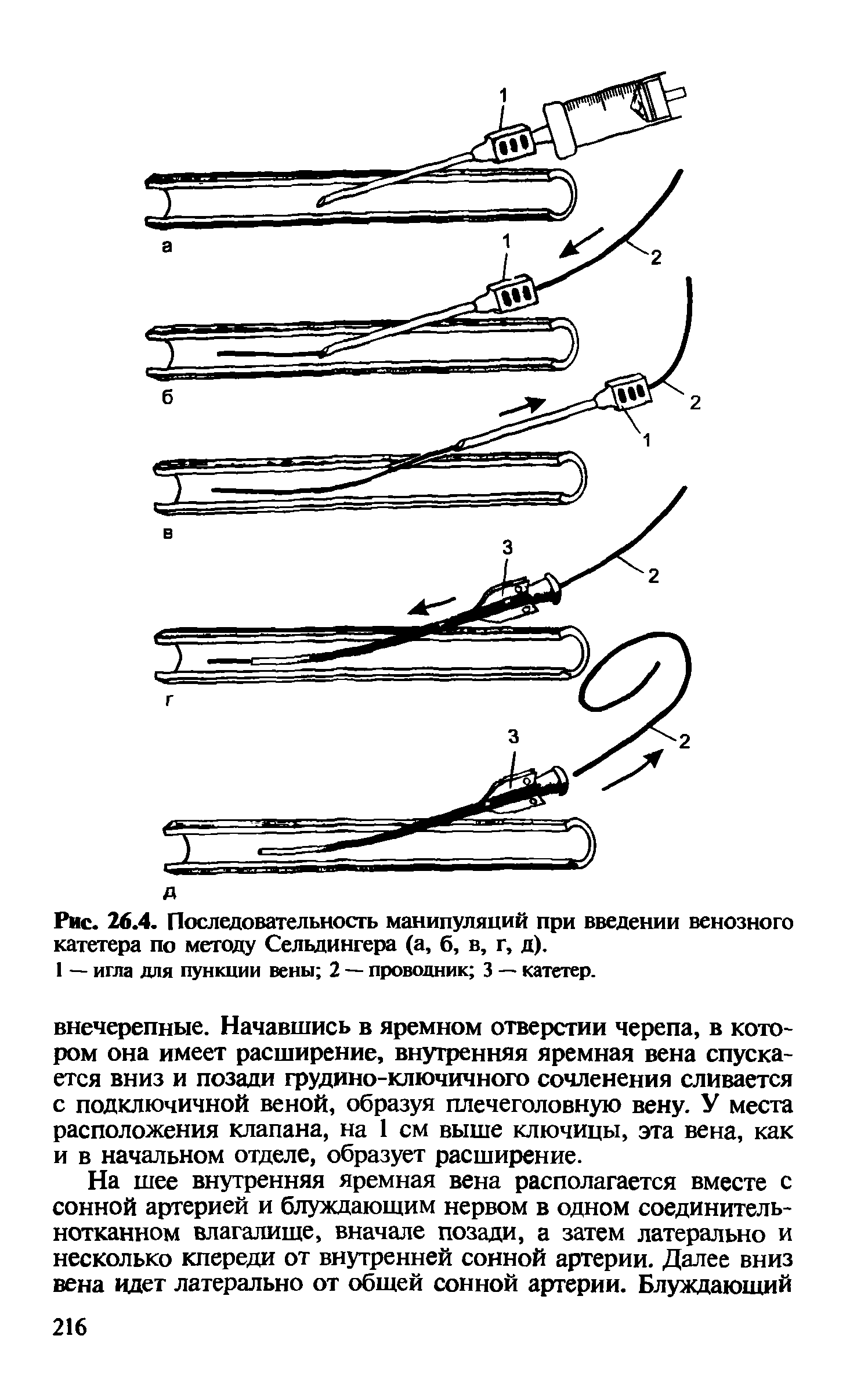 Рис. 26.4. Последовательность манипуляций при введении венозного катетера по методу Сельдингера (а, б, в, г, д).