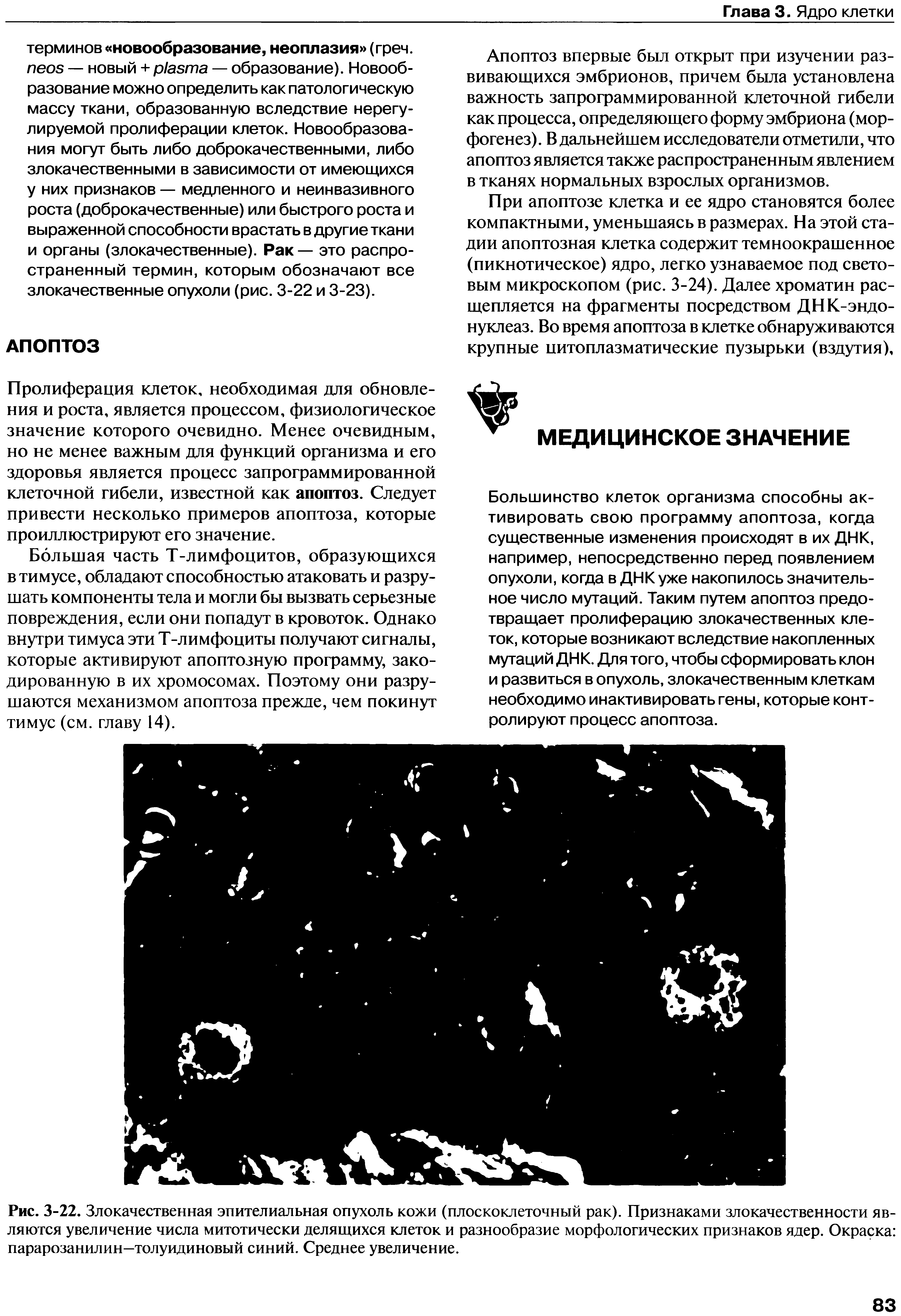 Рис. 3-22. Злокачественная эпителиальная опухоль кожи (плоскоклеточный рак). Признаками злокачественности являются увеличение числа митотически делящихся клеток и разнообразие морфологических признаков ядер. Окраска парарозанилин—толуидиновый синий. Среднее увеличение.