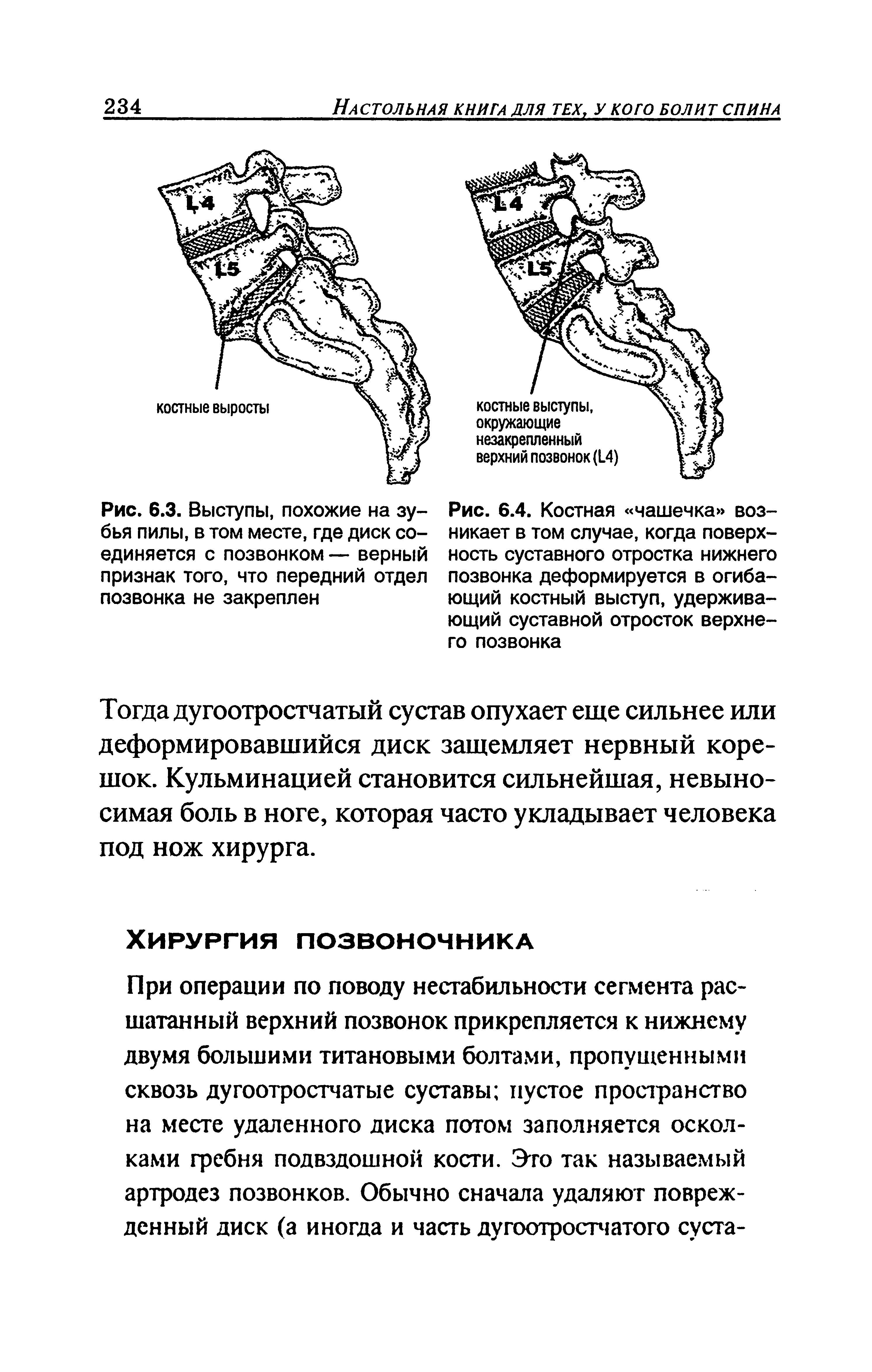 Рис. 6.4. Костная чашечка возникает в том случае, когда поверхность суставного отростка нижнего позвонка деформируется в огибающий костный выступ, удерживающий суставной отросток верхнего позвонка...