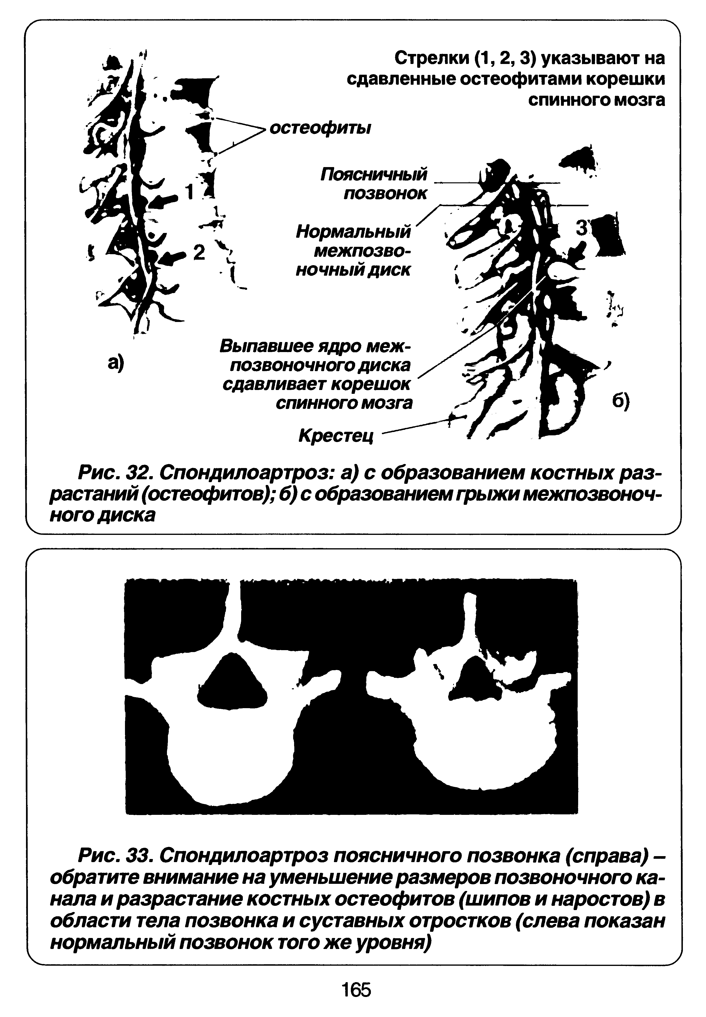 Рис. 33. Спондилоартроз поясничного позвонка (справа) -обратите внимание на уменьшение размеров позвоночного канала и разрастание костных остеофитов (шипов и наростов) в области тела позвонка и суставных отростков (слева показан нормальный позвонок того же уровня)...