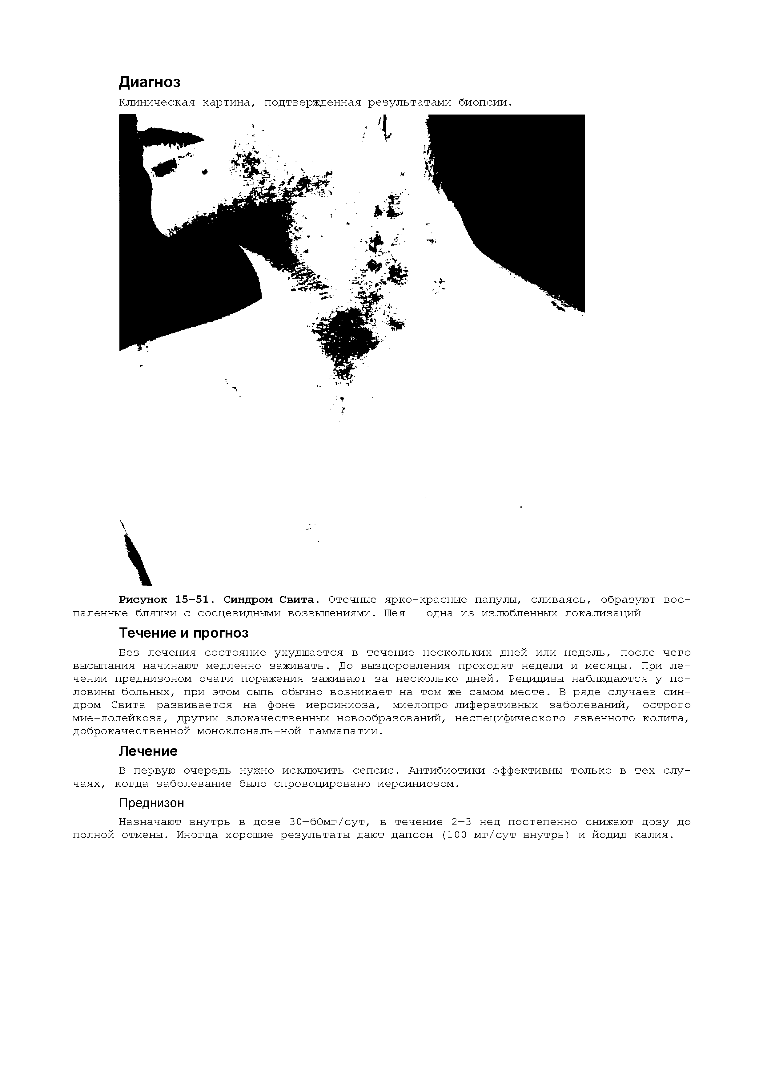 Рисунок 15-51. Синдром Свита. Отечные ярко-красные папулы, сливаясь, образуют воспаленные бляшки с сосцевидными возвышениями. Шея — одна из излюбленных локализаций...