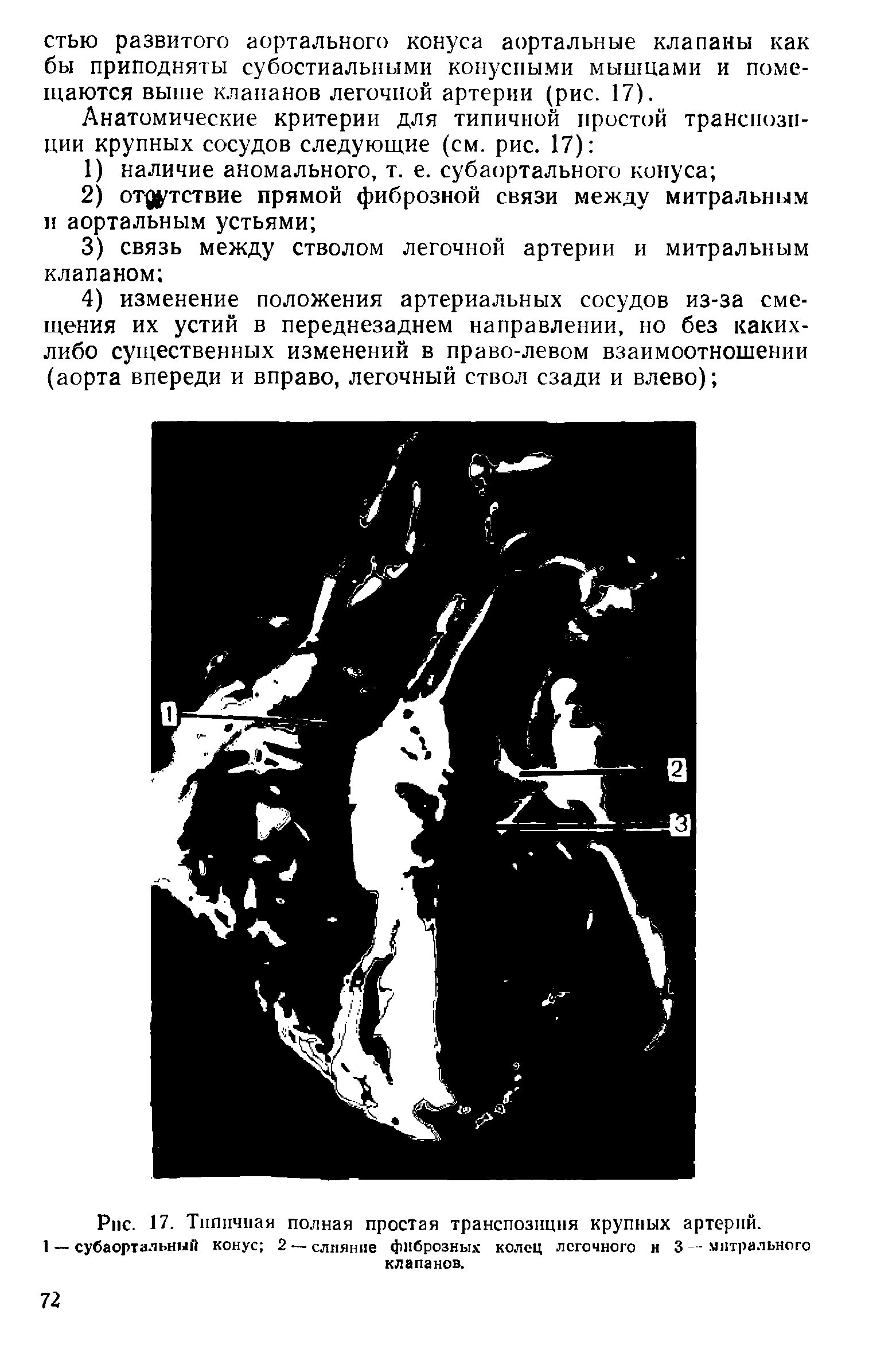 Рис. 17. Типичная полная простая транспозиция крупных артерий.