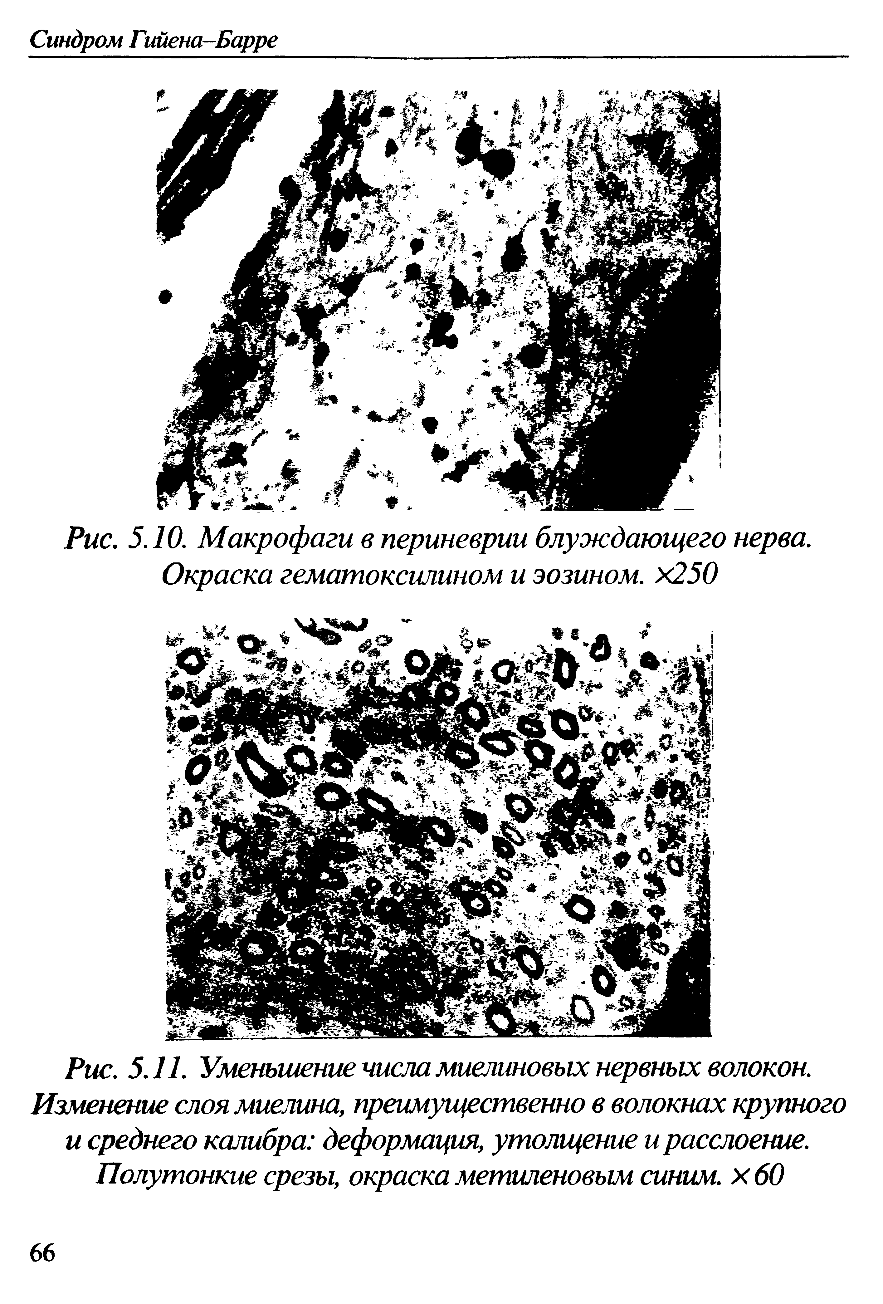 Рис. 5.11. Уменьшение числа миелиновых нервных волокон. Изменение слоя миелина, преимущественно в волокнах крупного и среднего калибра деформация, утолщение и расслоение. Полутонкие срезы, окраска метиленовым синим х 60...