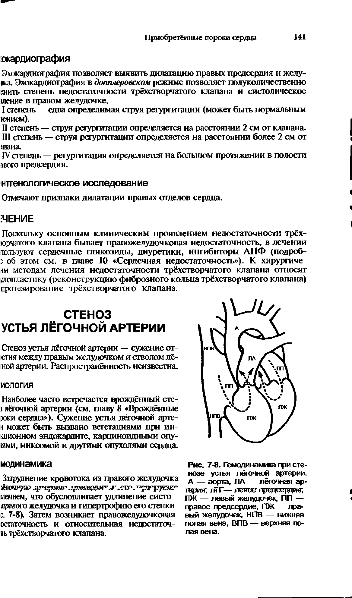 Рис. 7-8. Гемодинамика при стенозе устья лёгочной артерии. А — аорта, ЛА — лёгочная артерия, гйТ— левее предсердие ЛЖ — левый желудочек, ПП — гравое предсердие, ПЖ — гра-вый желудочек, НПВ — нижняя полая вена, ВПВ — верхняя лопая вена.