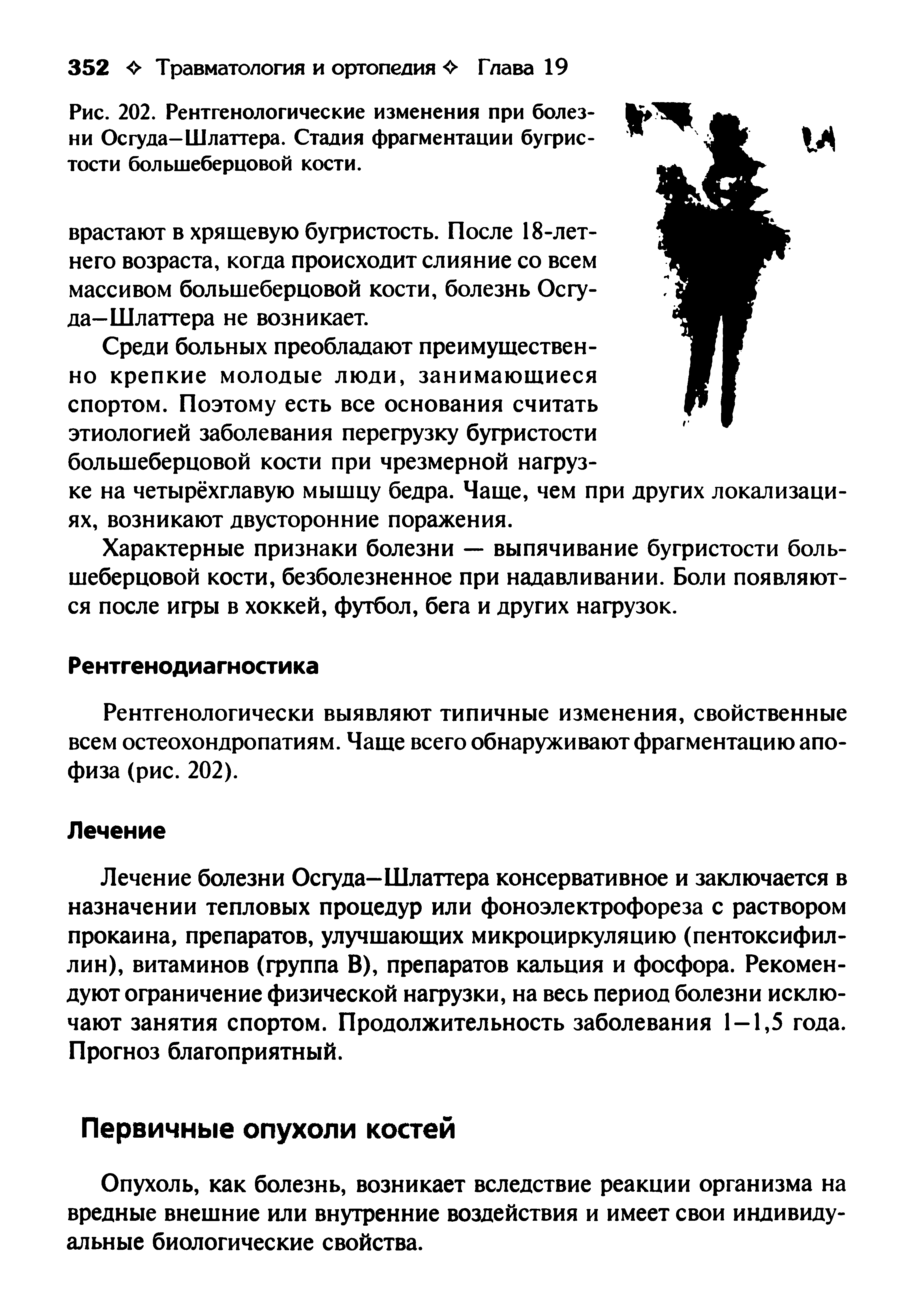 Рис. 202. Рентгенологические изменения при болезни Осгуда-Шлаттера. Стадия фрагментации бугристости большеберцовой кости.