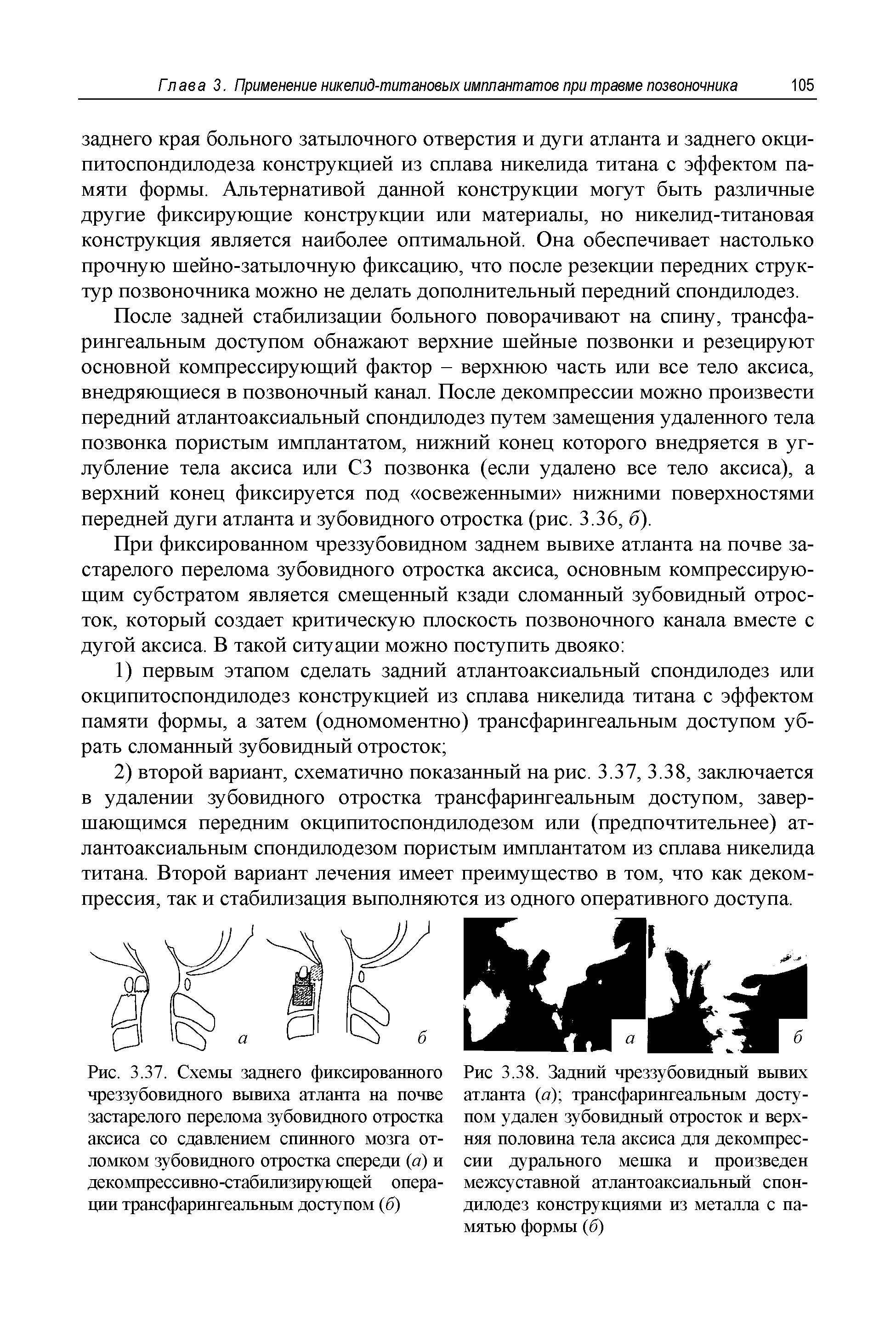 Рис. 3.37. Схемы заднего фиксированного чреззубовидного вывиха атланта на почве застарелого перелома зубовидного отростка аксиса со сдавлением спинного мозга отломком зубовидного отростка спереди (а) и декомпрессивно-стабилизирующей операции трансфарингеальным доступом (б)...