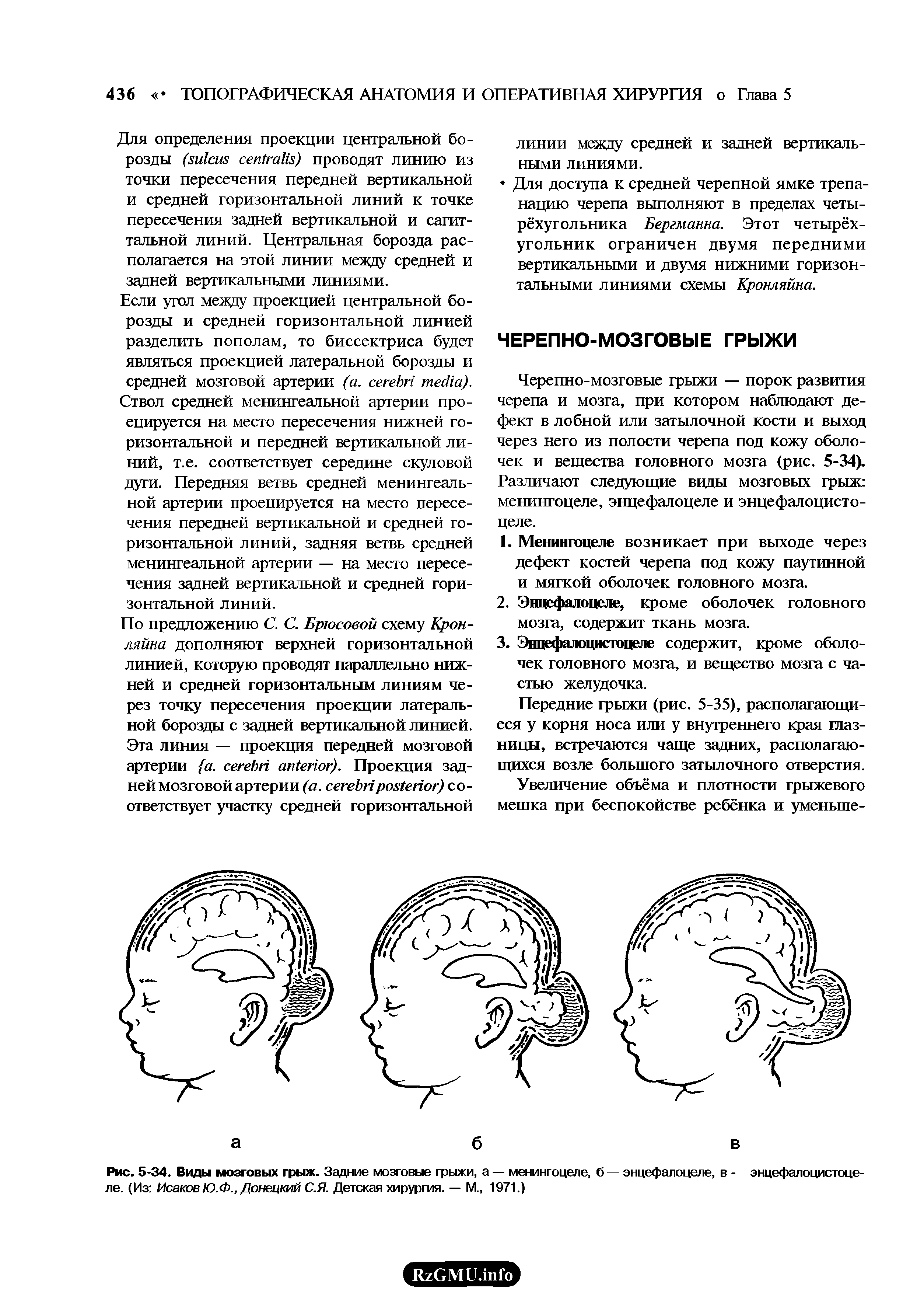 Рис. 5-34. Виды мозговых грыж. Задние мозговые грыжи, а — менингоцеле, б — энцефалоцеле, в - энцефалоцистоцеле. (Из Исаков Ю.Ф., Донецкий С.Я. Детская хирургия. — М., 1971.)...