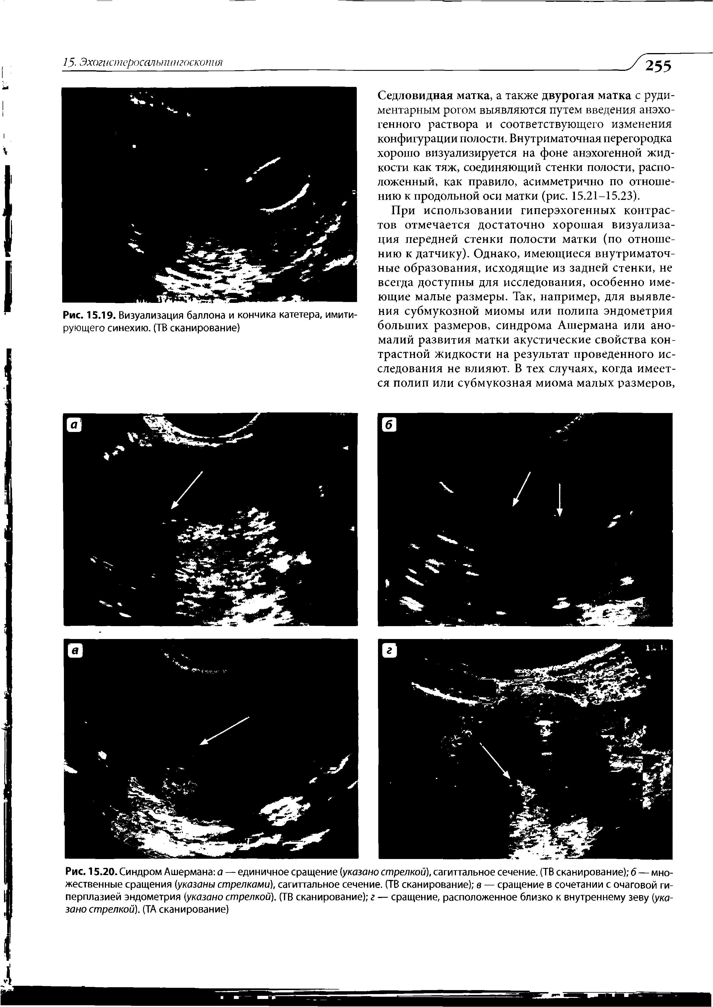 Рис. 15.20. Синдром Ашермана а — единичное сращение (указано стрелкой), сагиттальное сечение. (ТВ сканирование) 6 — множественные сращения (указаны стрелками), сагиттальное сечение. (ТВ сканирование) в — сращение в сочетании с очаговой гиперплазией эндометрия (указано стрелкой). (ТВ сканирование) г — сращение, расположенное близко к внутреннему зеву (указано стрелкой). (ТА сканирование)...