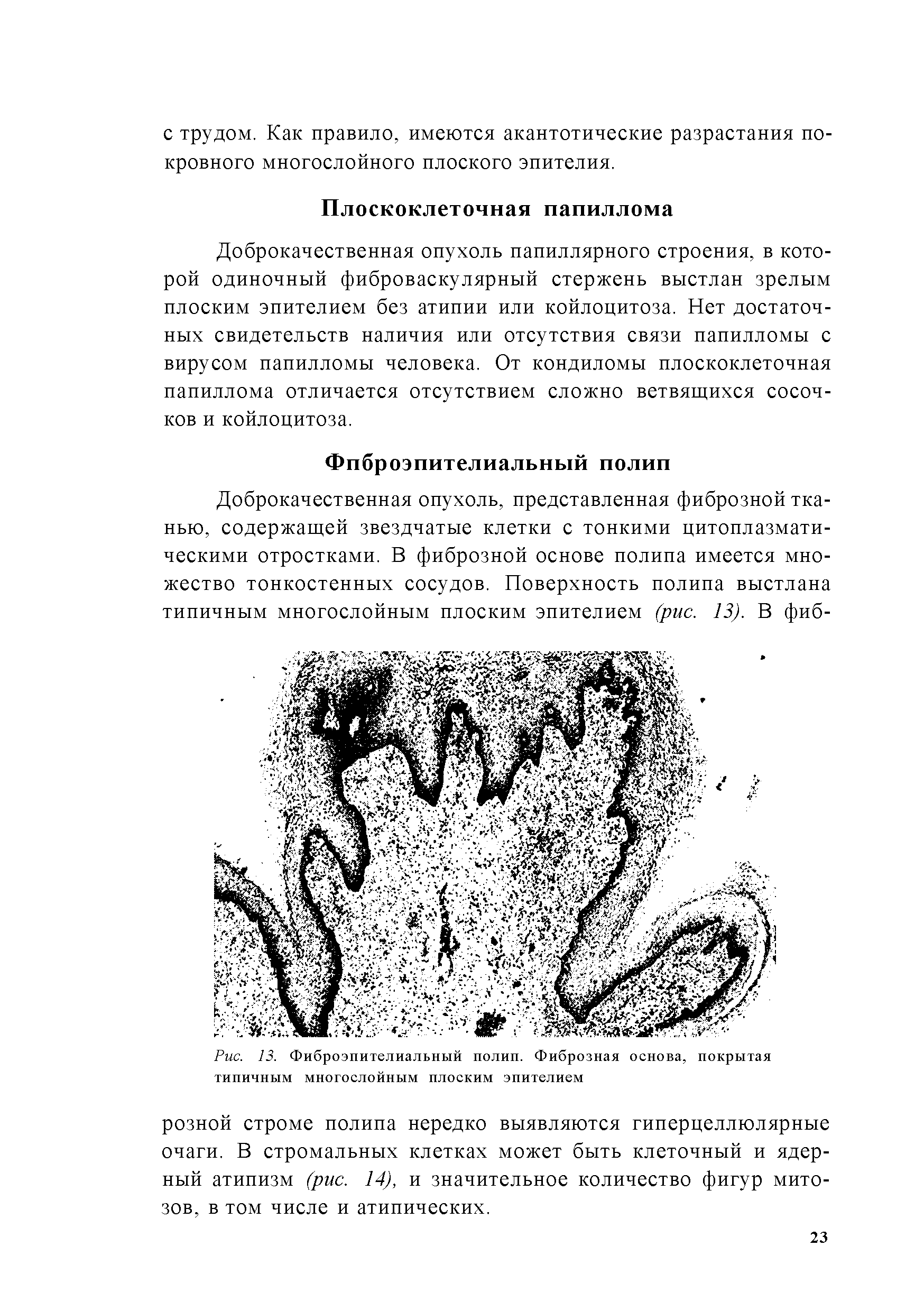 Рис. 13. Фиброэпителиальный полип. Фиброзная основа, покрытая типичным многослойным плоским эпителием...