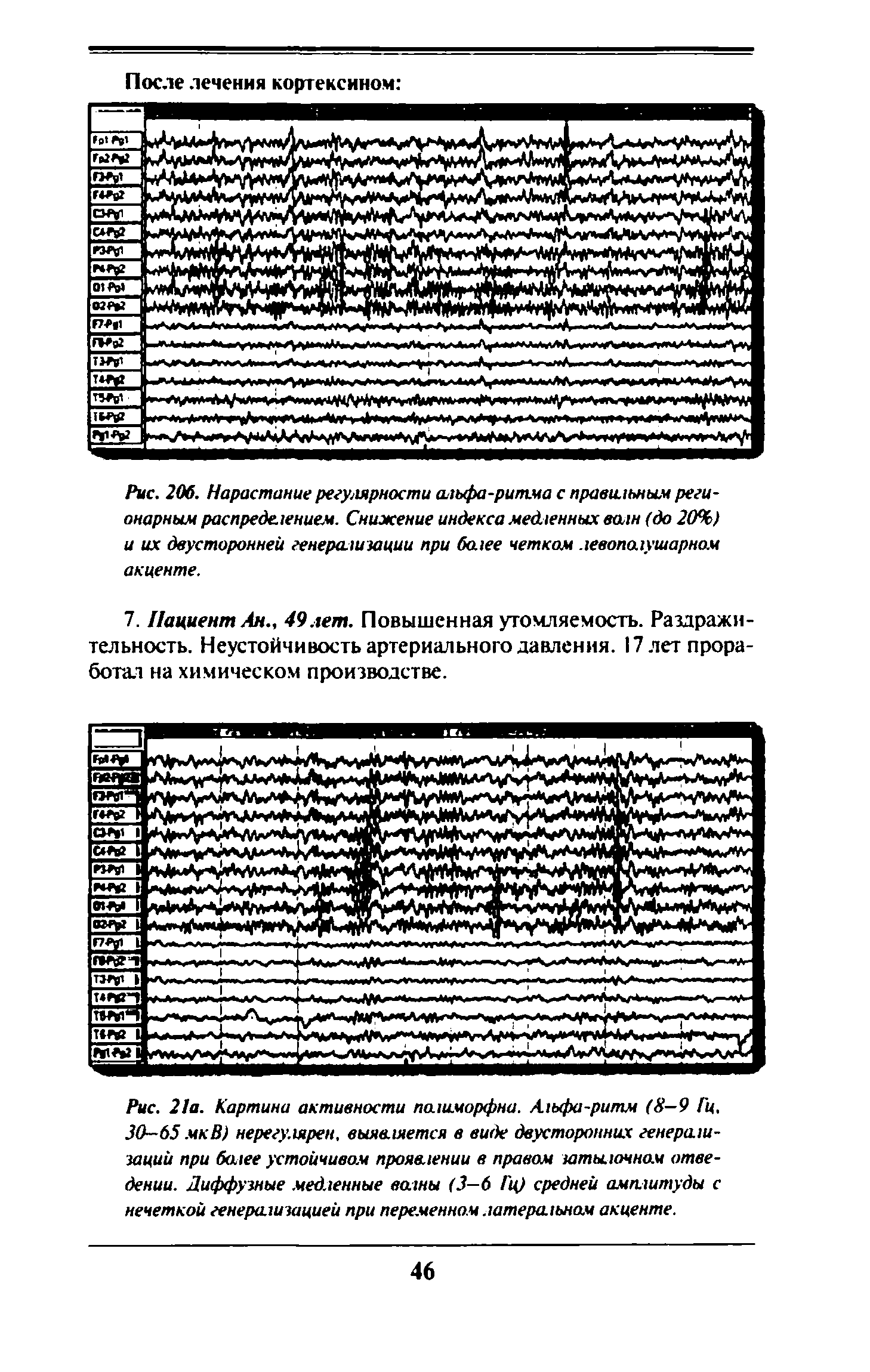 Рис. 206. Нарастание регулярности альфа-ритма с правильным регионарным распределением. Снижение индекса медленных волн (до 20%) и их двусторонней генерализации при более четком левополушарном акценте.