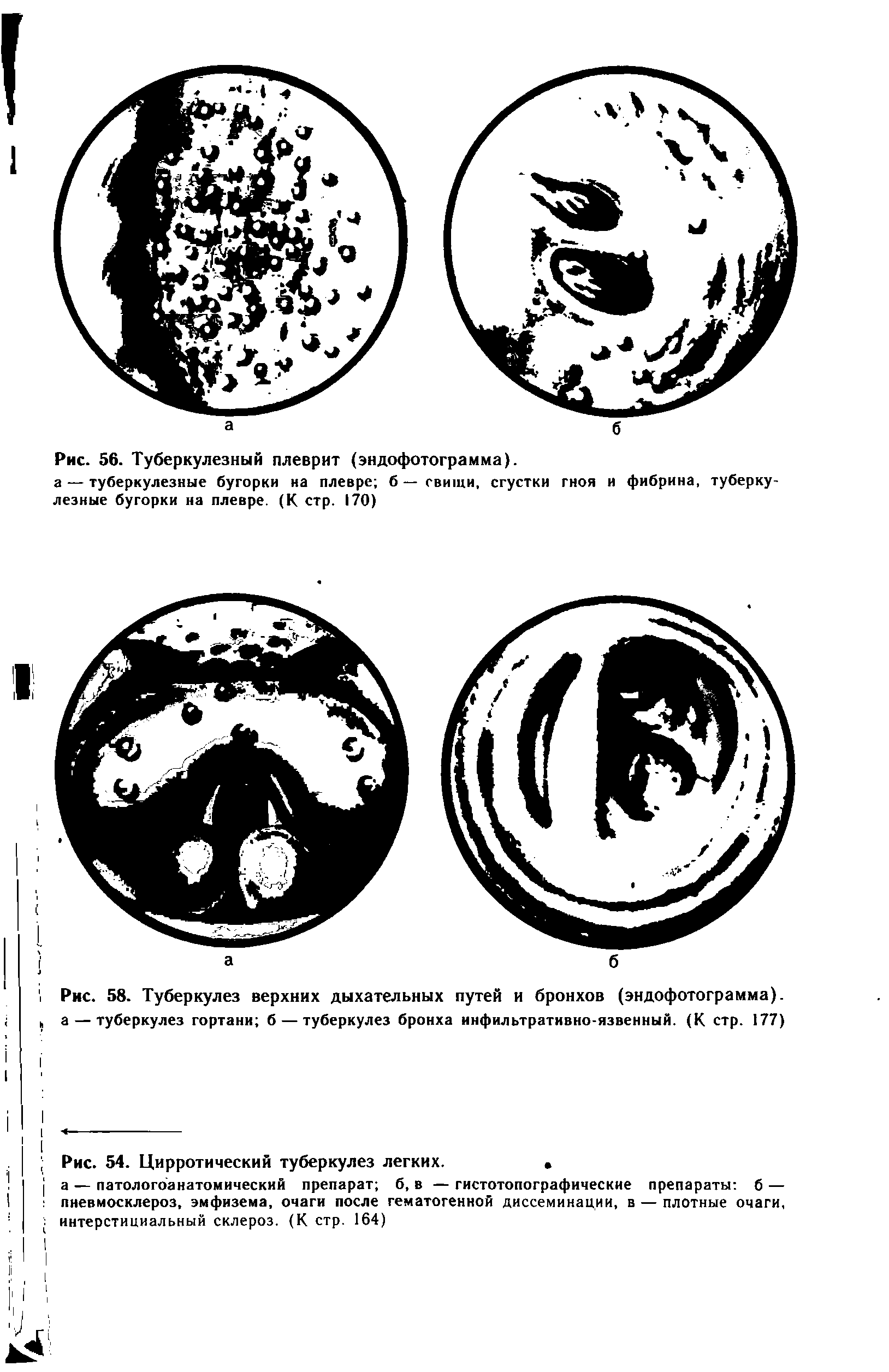 Рис. 58. Туберкулез верхних дыхательных путей и бронхов (эндофотограмма), а — туберкулез гортани б — туберкулез бронха инфильтративно-язвенный. (К стр. 177)...