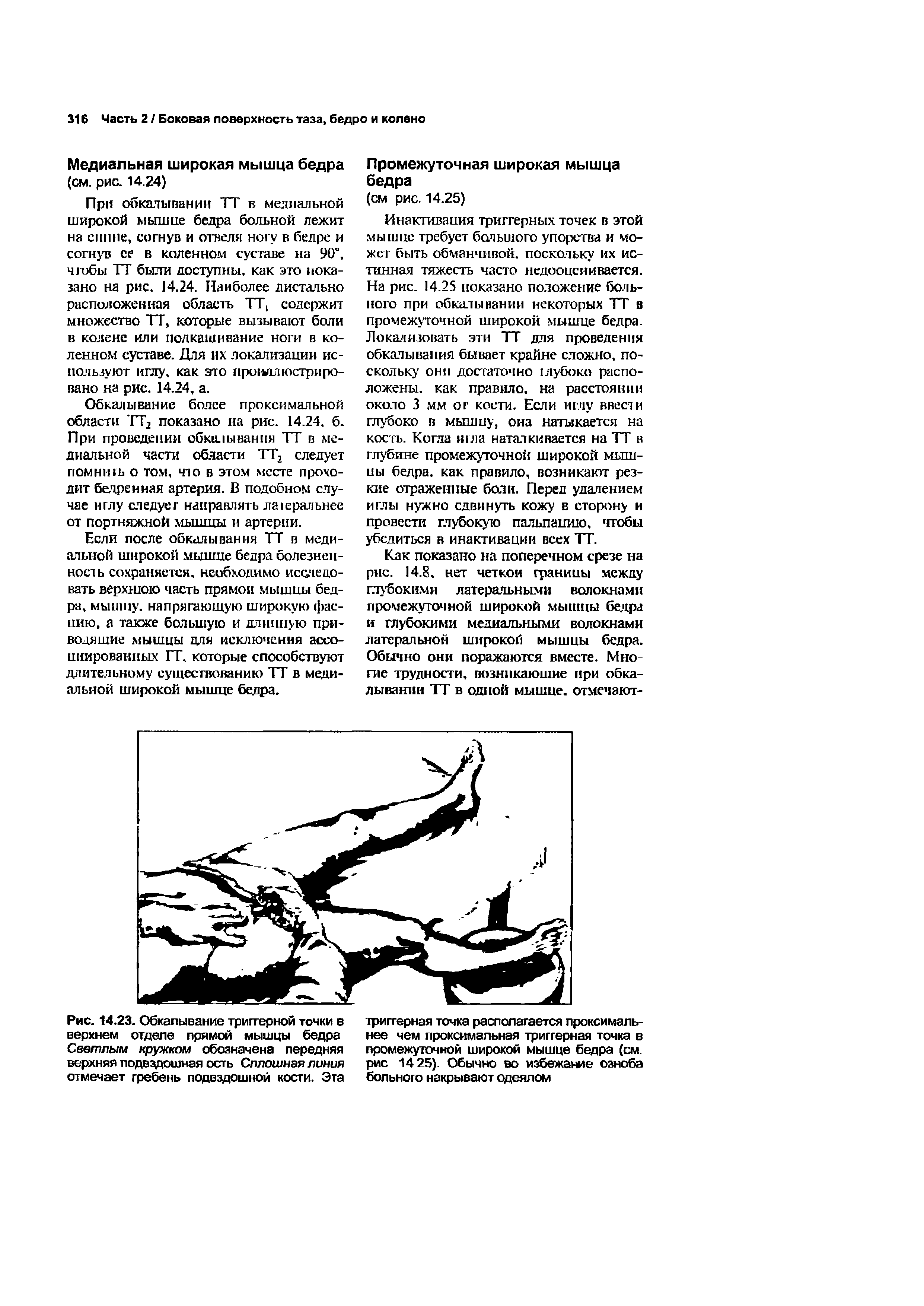 Рис. 14.23. Обкалывание триггерной точки в верхнем отделе прямой мышцы бедра Светлым кружком обозначена передняя верхняя подвздошная ость Сплошная линия отмечает гребень подвздошной кости. Эта...