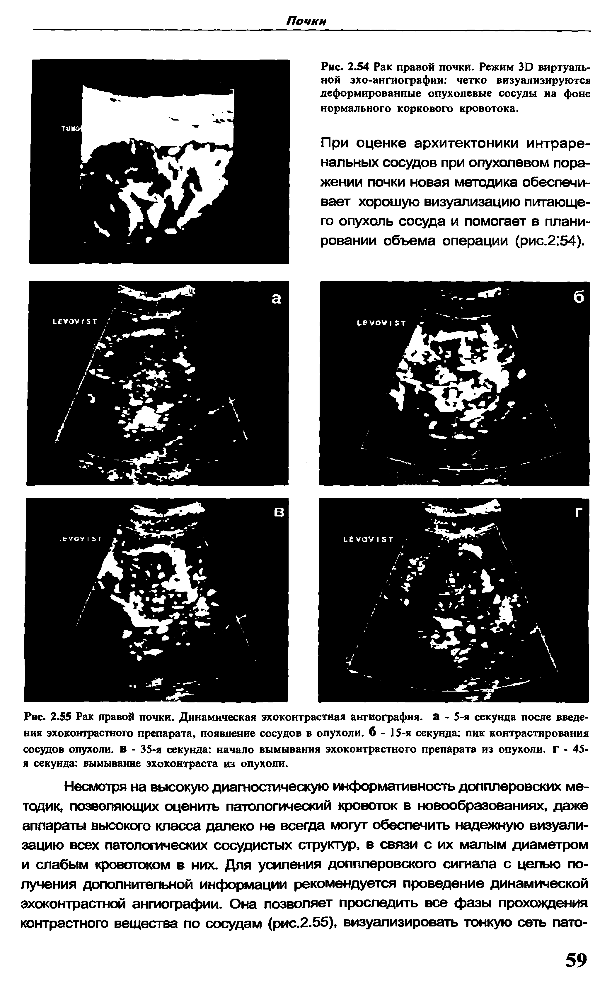 Рис. 2.55 Рак правой почки. Динамическая эхоконтрастная ангиография, а - 5-я секунда после введения эхоконтрастного препарата, появление сосудов в опухоли, б - 15-я секунда пик контрастирования сосудов опухоли, в - 35-я секунда начало вымывания эхоконтрастного препарата из опухоли. Г - 45-я секунда вымывание эхоконтраста из опухоли.