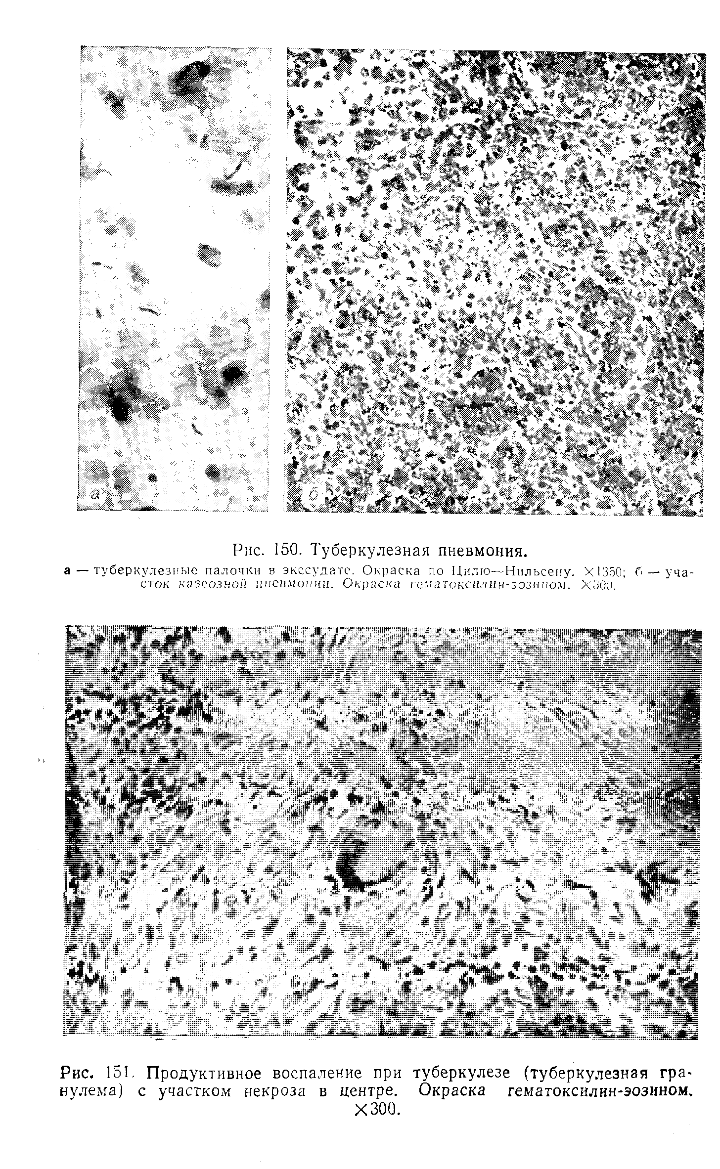 Рис. 151. Продуктивное воспаление при туберкулезе (туберкулезная гранулема) с участком некроза в центре. Окраска гематоксилин-эозином.