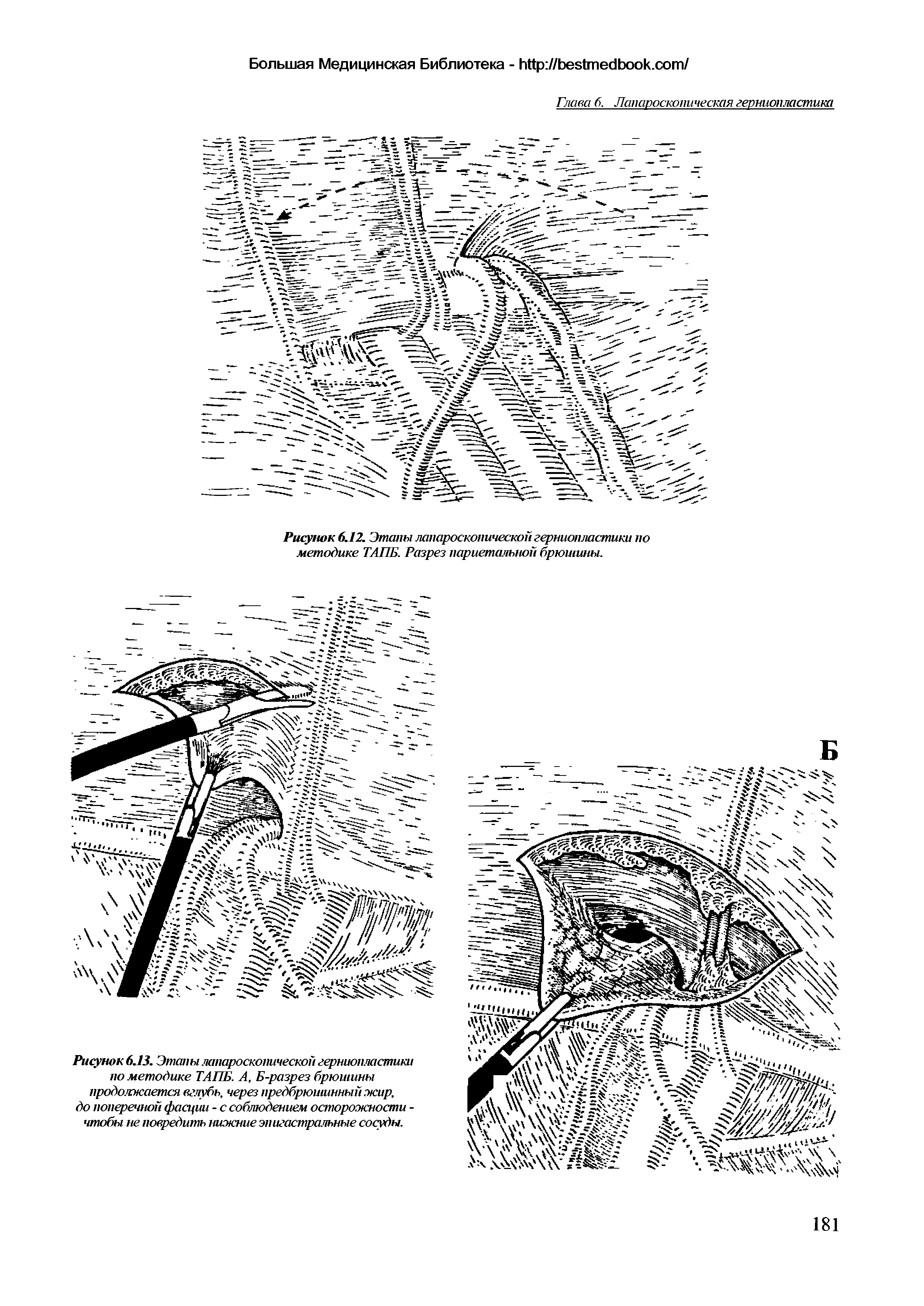 Рисунок 6.13. Этапы лапароскопической герниопластика по методике ТАПБ. А, Б-разрез брюшины продолжается вглубь, через предбрюишнныйжир, до поперечной фасции - с соблюдением осторожности -чтобы не повредить нижние эпигастральные сосуды.