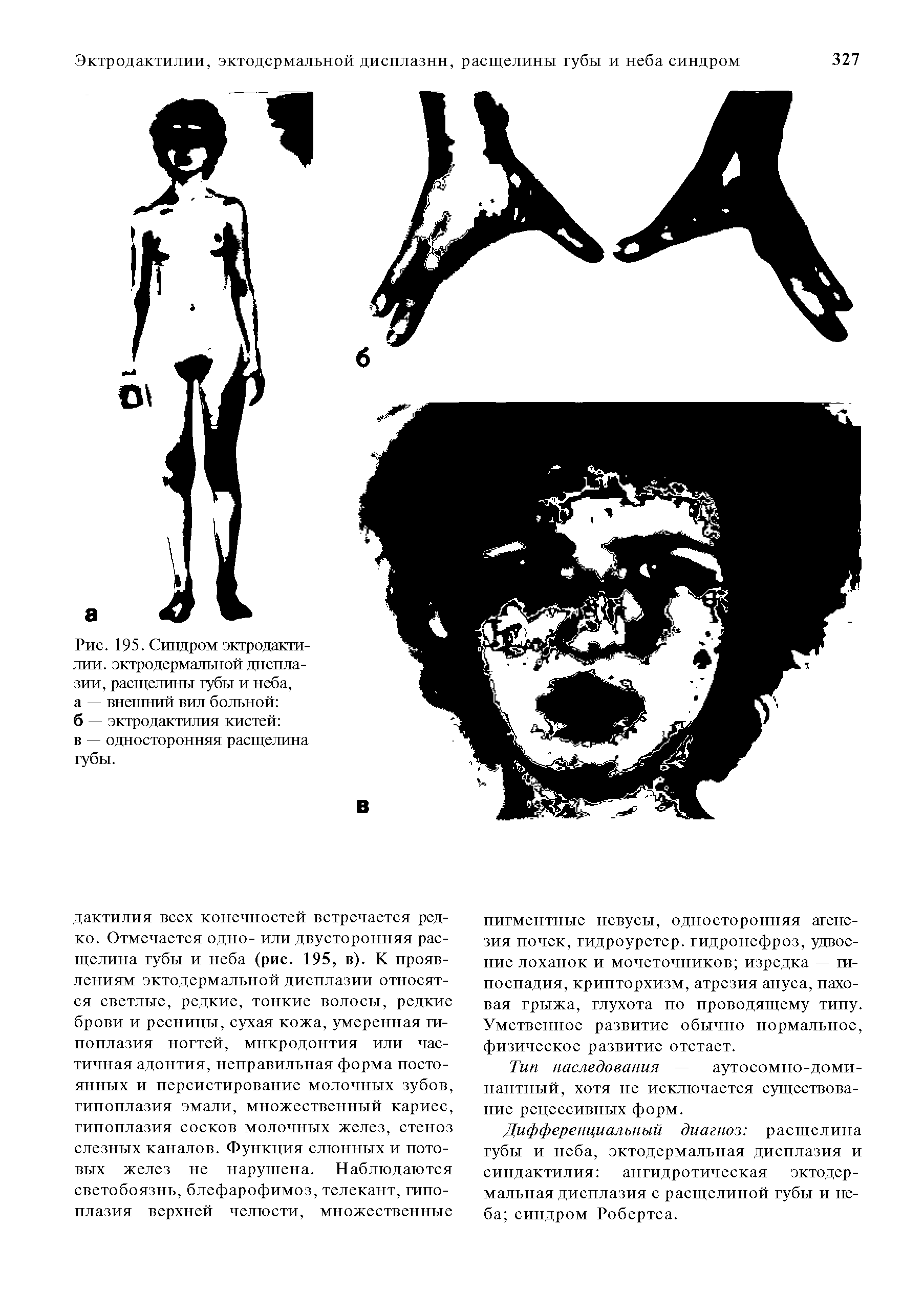 Рис. 195. Синдром эктродактилии. эктродермальной дисплазии, расщелины губы и неба, а — внешний вил больной б — эктродактилия кистей в — односторонняя расщелина губы.