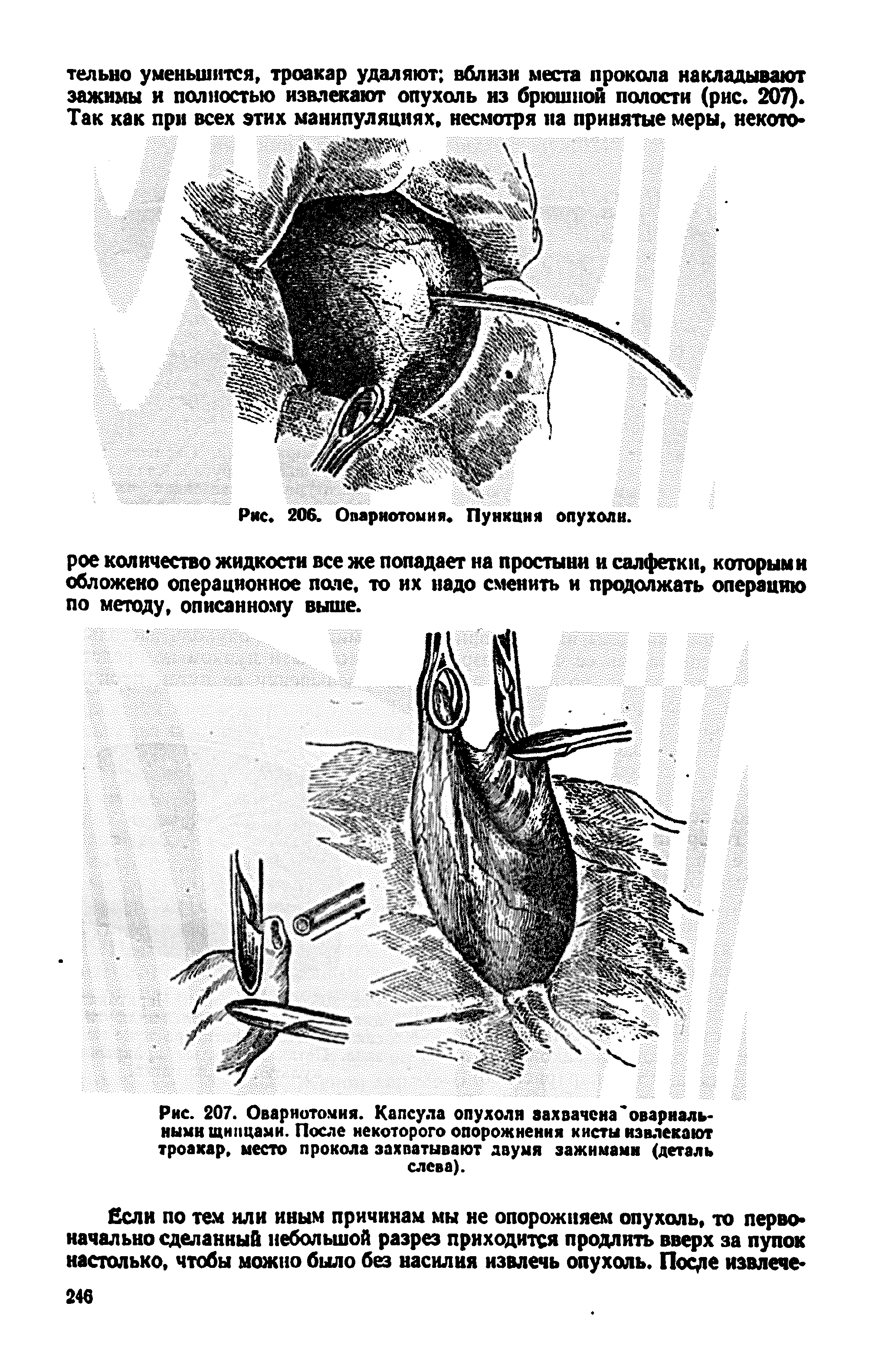 Рис. 207. Овариотомия. Капсула опухоли захвачена овариальными щипцами. После некоторого опорожнения кисты извлекают троакар, место прокола захватывают двумя зажимами (деталь слева).