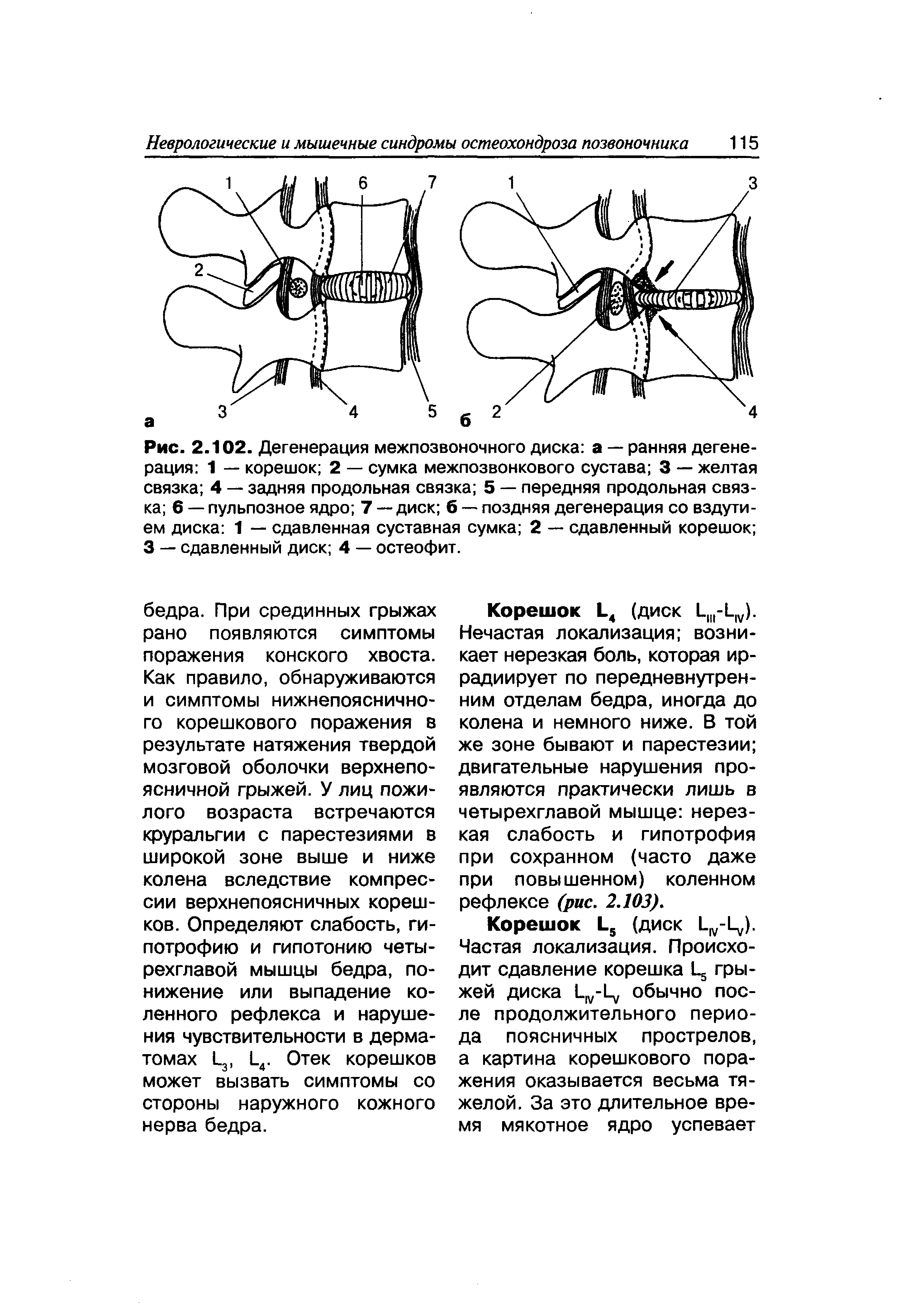 Рис. 2.102. Дегенерация межпозвоночного диска а — ранняя дегенерация 1 — корешок 2 — сумка межпозвонкового сустава 3 — желтая связка 4 — задняя продольная связка 5 — передняя продольная связка 6 — пульпозное ядро 7 — диск б — поздняя дегенерация со вздутием диска 1 — сдавленная суставная сумка 2 — сдавленный корешок 3 — сдавленный диск 4 — остеофит.