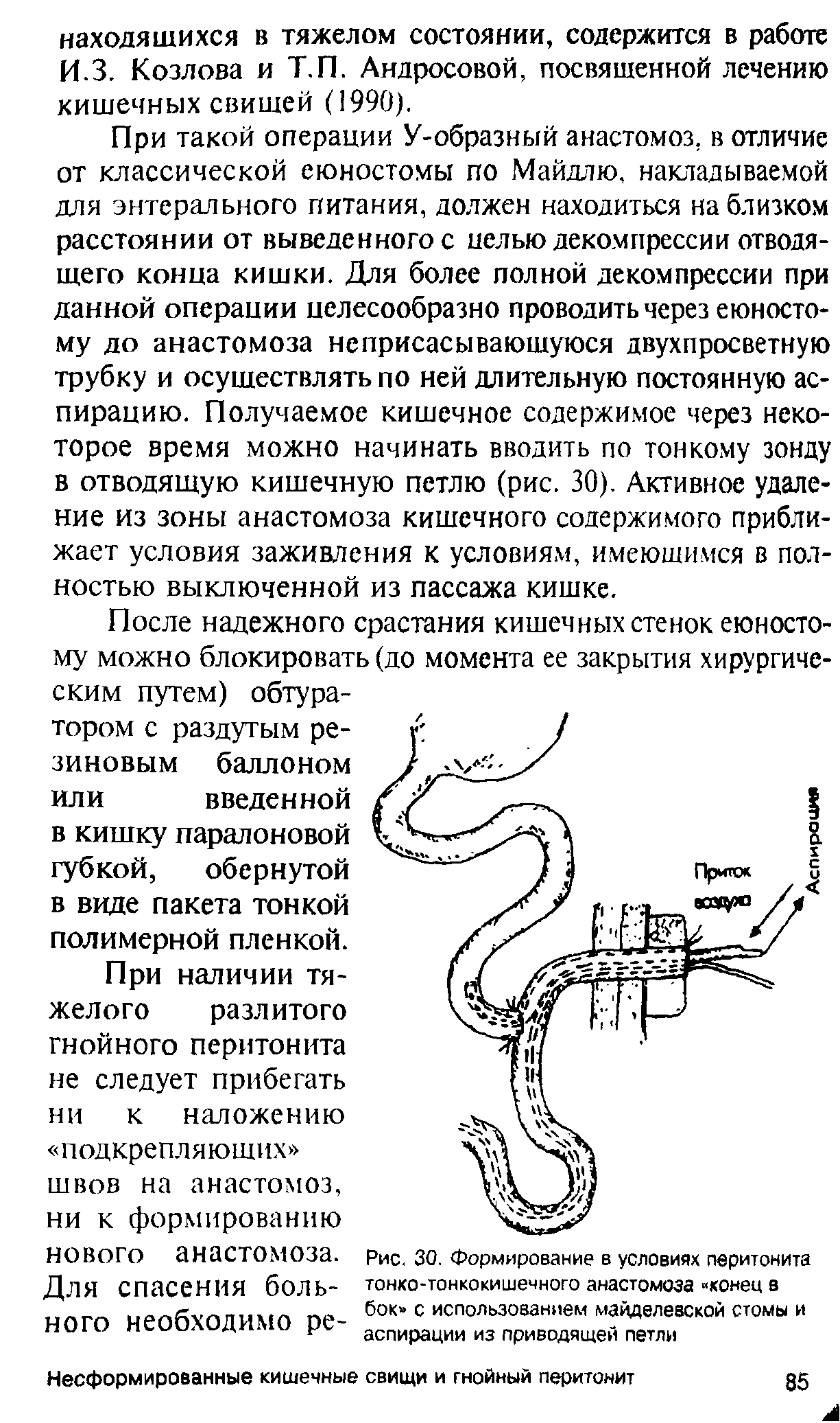 Рис. 30. Формирование в условиях перитонита тонко-тонкокишечного анастомоза конец в бок с использованием майделевской стомы и аспирации из приводящей петли...