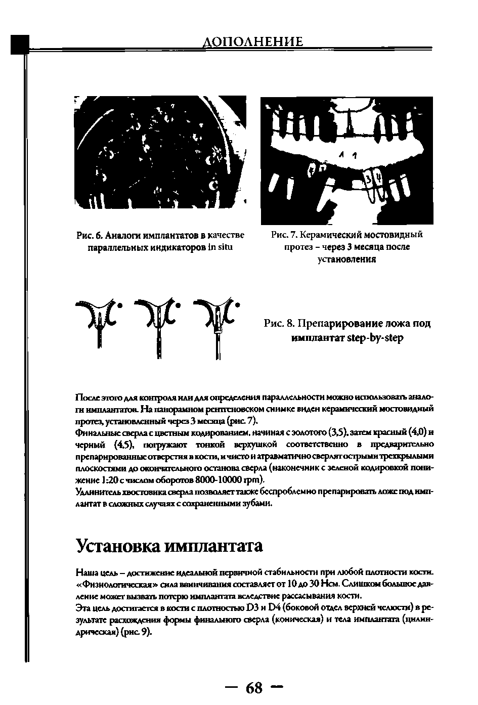 Рис. 7. Керамический мостовидный протез - через 3 месяца после...